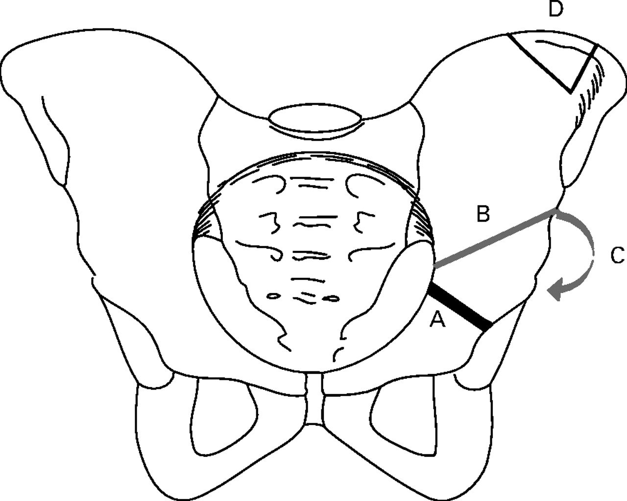 Modified Salter osteotomy for the treatment of developmental dysplasia ...