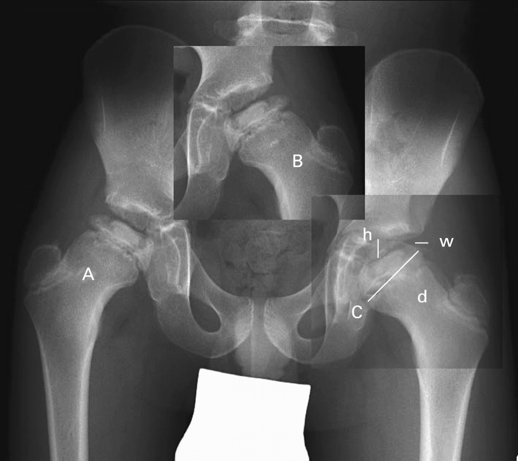 The deformity index as a predictor of final radiological outcome in ...