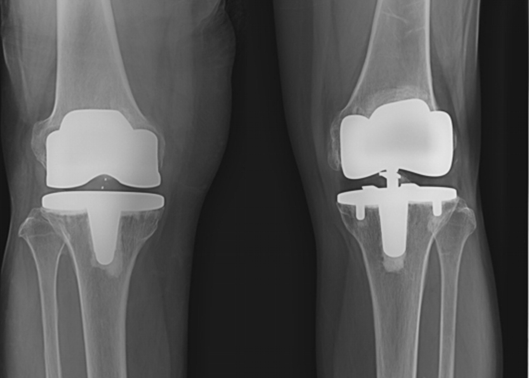 The long-term results of simultaneous fixed-bearing and mobile-bearing ...