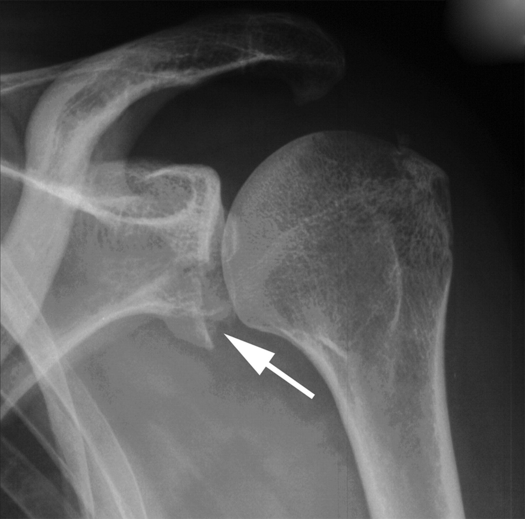 Non-operative treatment of large anterior glenoid rim fractures after ...