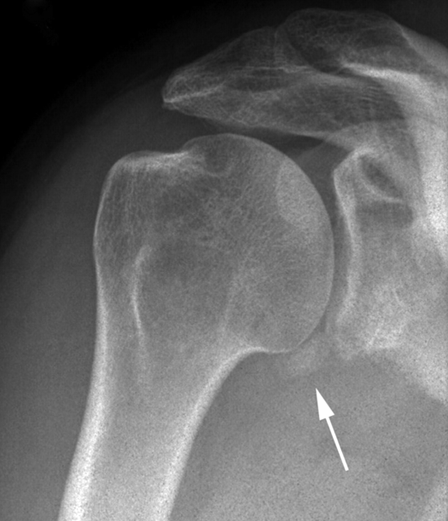 Non-operative Treatment Of Large Anterior Glenoid Rim Fractures After ...