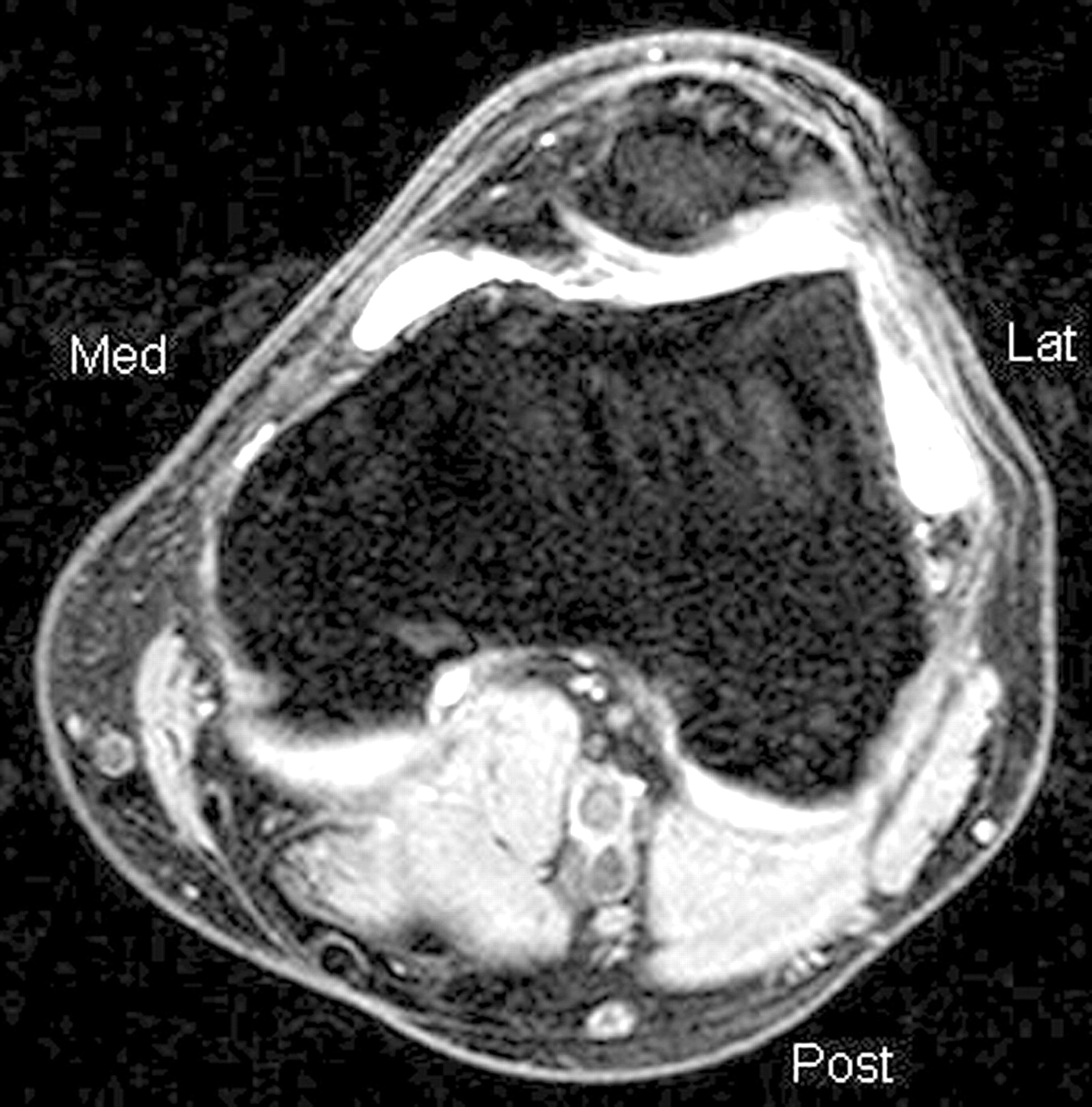 Anatomical variations in vastus medialis obliquus and its implications ...