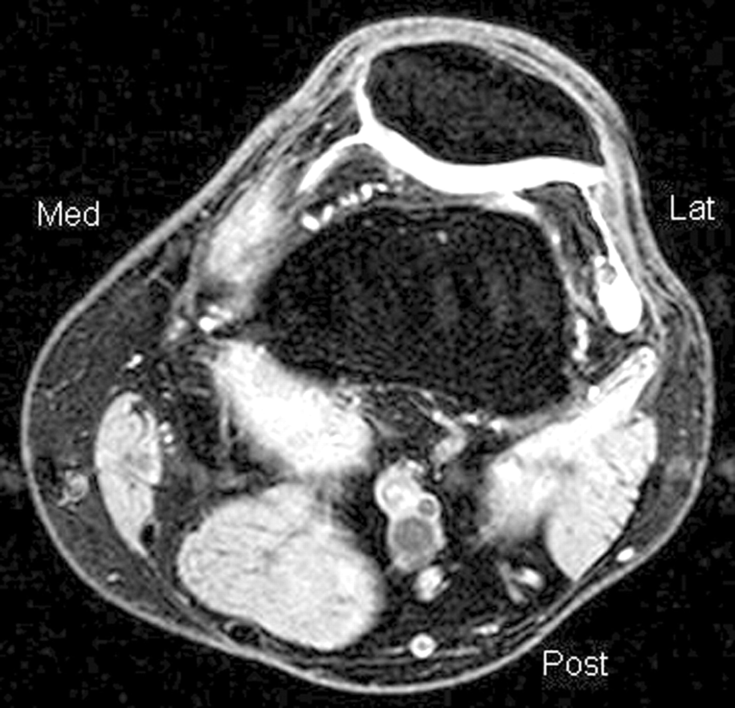 Anatomical variations in vastus medialis obliquus and its implications ...