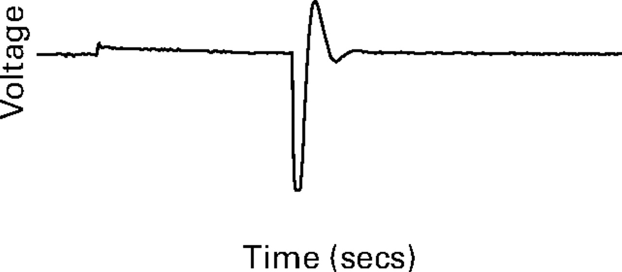 Fig. 1a, Fig. 1b, Fig. 1c  
            Diagrams of the waveform of the non-invasive neurostimulation device showing a) no skin contact, b) high-impedance skin contact, and c) low-impedance skin contact. The waveform dynamically adjusts in relation to changes in the skin. This allows localisation of sites of low impedance which are then specifically targeted. Conductive gel is not required.
          