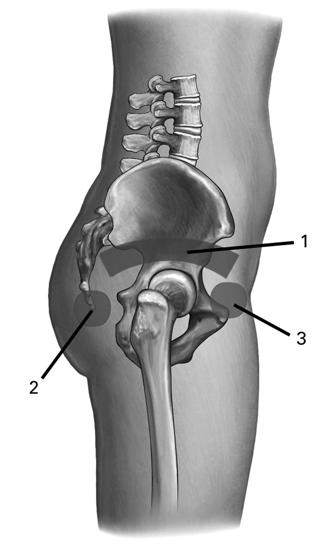 Fig. 2  
            Diagram of the sites of treatment which include 1) the skin just above the primary surgical incision, 2) the buttock area posterior to the hip, and 3) the skin infero-lateral to the anterior superior iliac spine (areas of deeper grey shading).
          