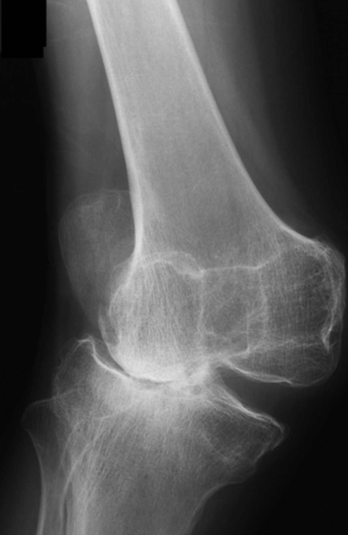 Total knee replacement for osteoarthritis of the knee with congenital ...