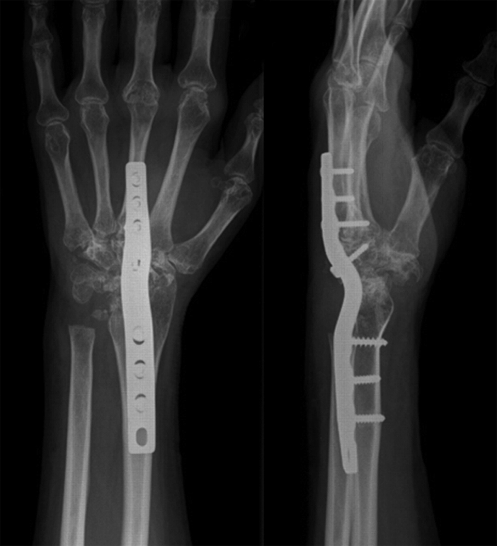 Fusion Of The Wrist In Rheumatoid Arthritis Bone Joint
