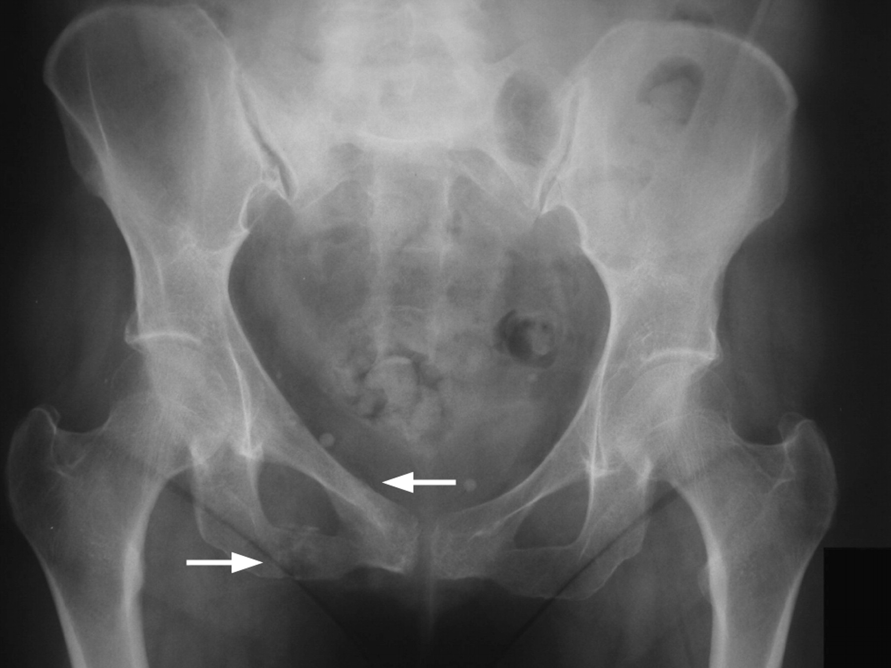 Percutaneous screw fixation for sacral insufficiency fractures | Bone ...