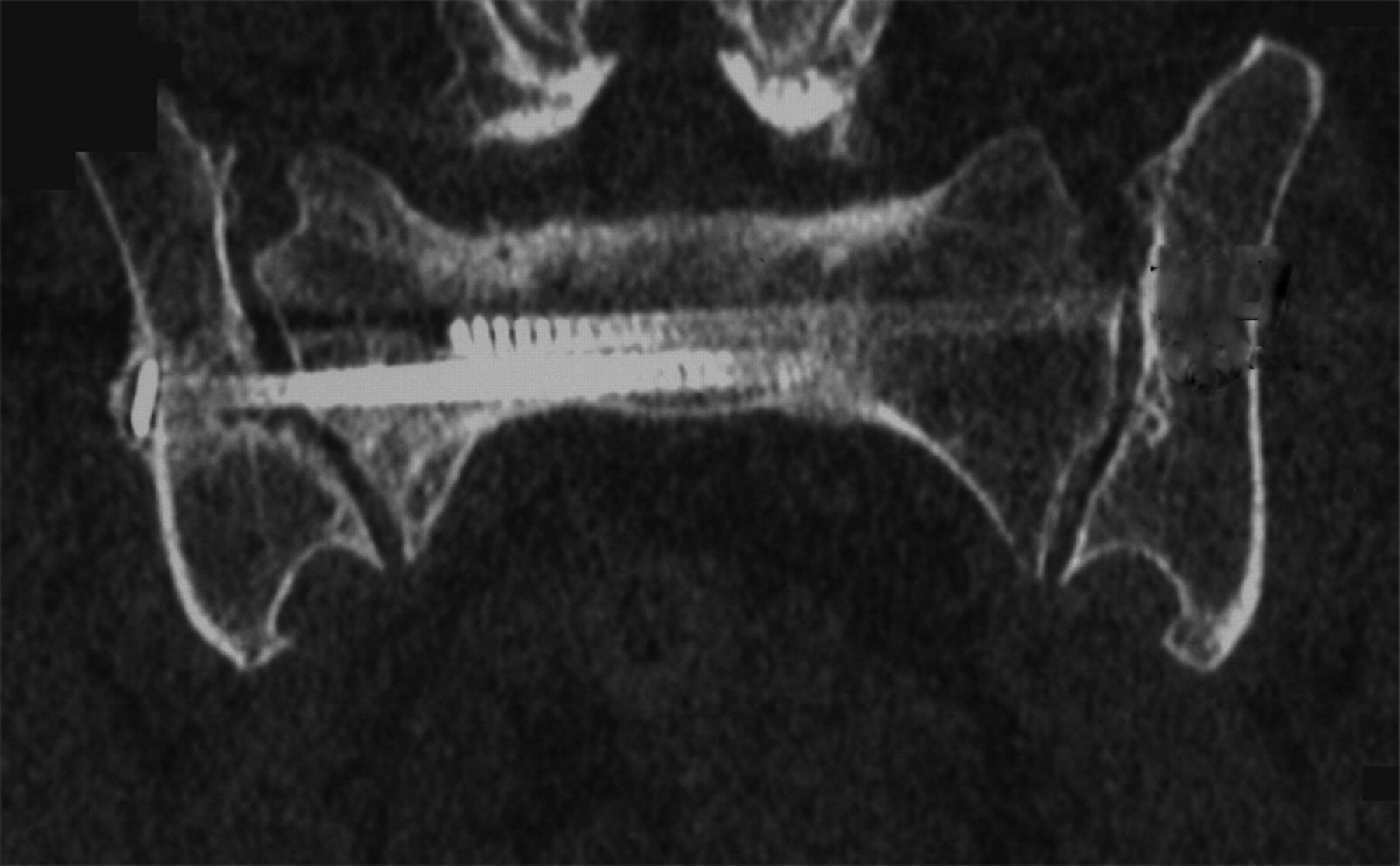 Percutaneous Screw Fixation For Sacral Insufficiency Fractures Bone