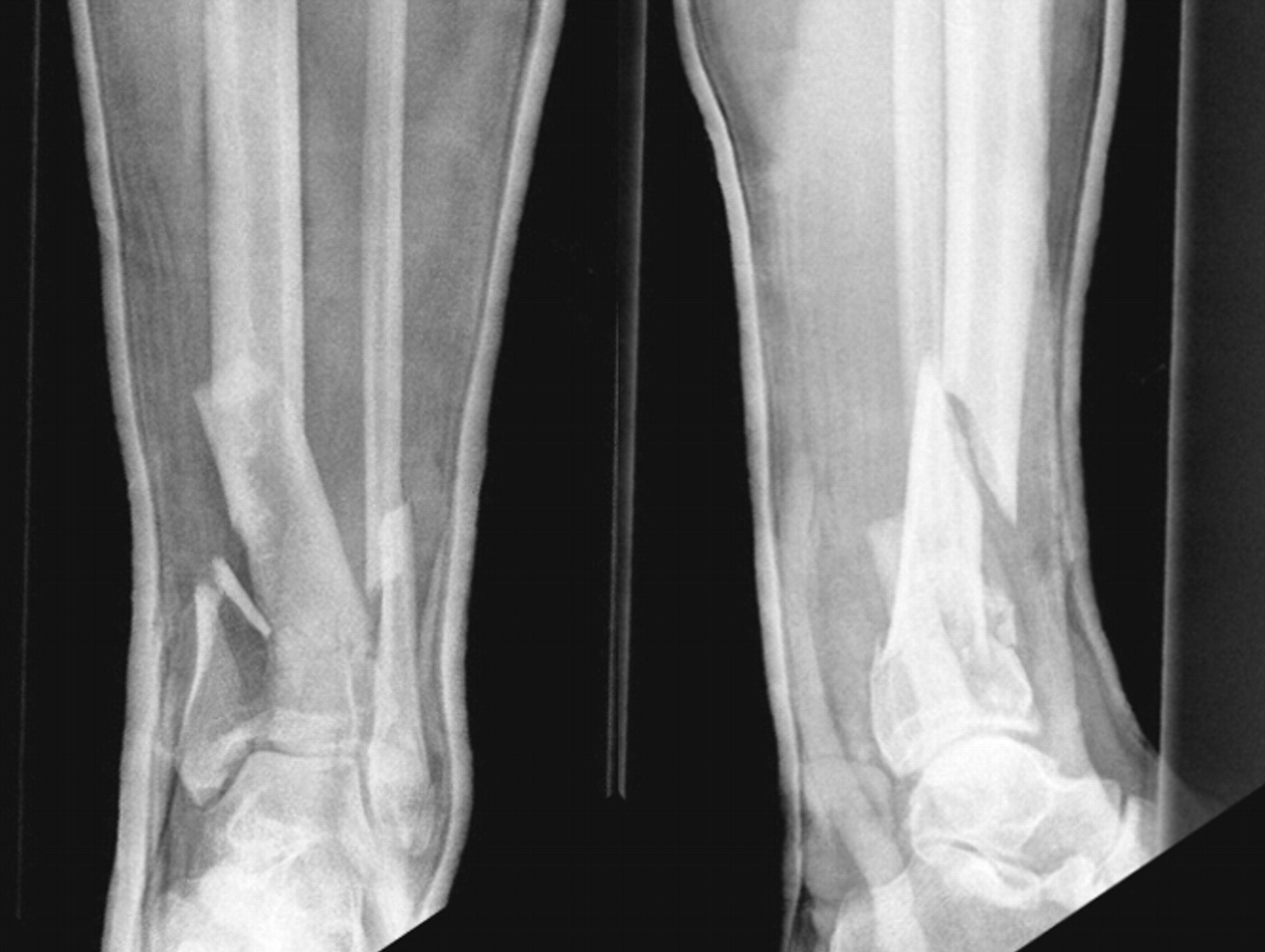 Rhbmp 7 Accelerates The Healing In Distal Tibial Fractures Treated By