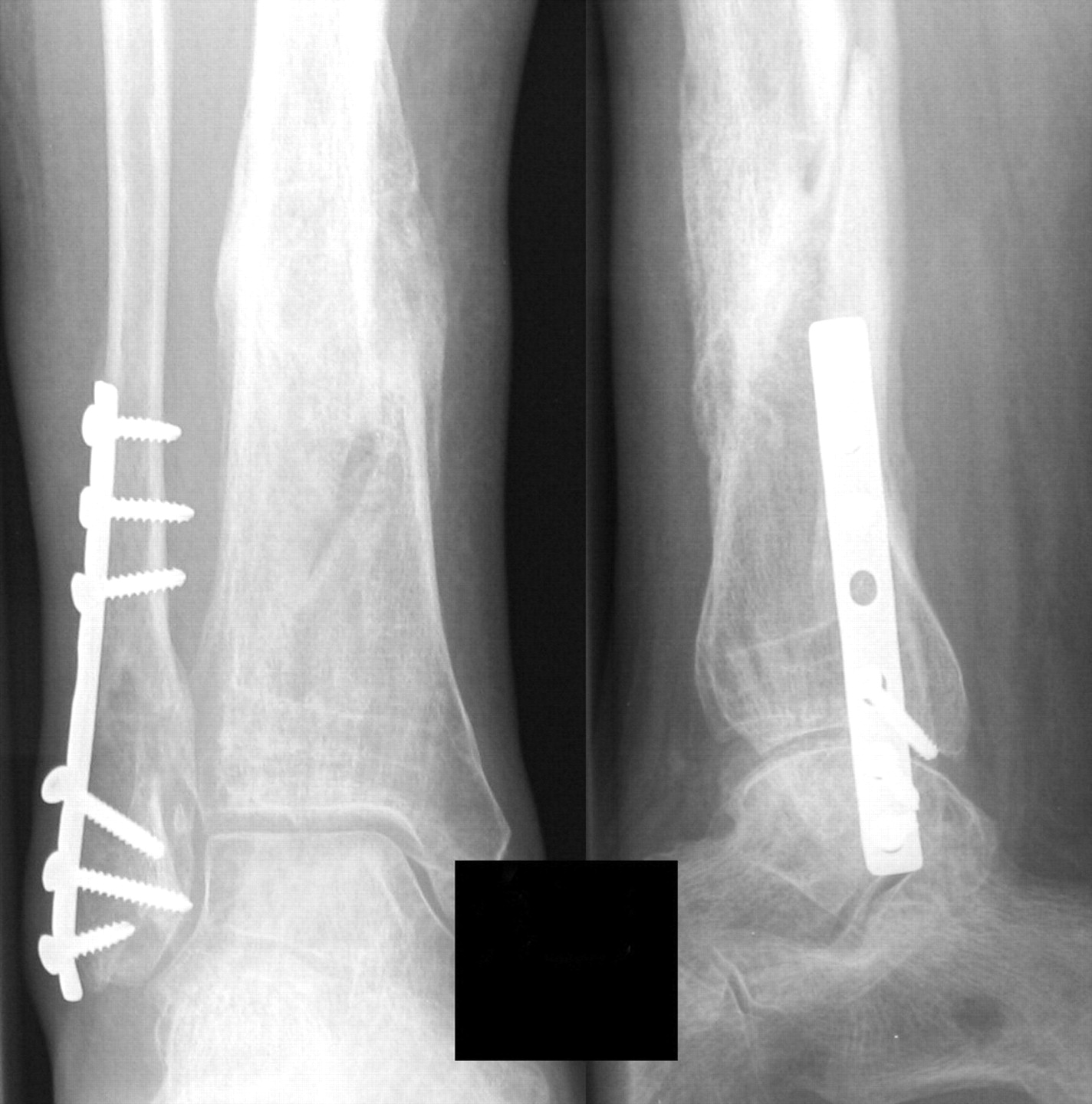 Rhbmp 7 Accelerates The Healing In Distal Tibial Fractures Treated By