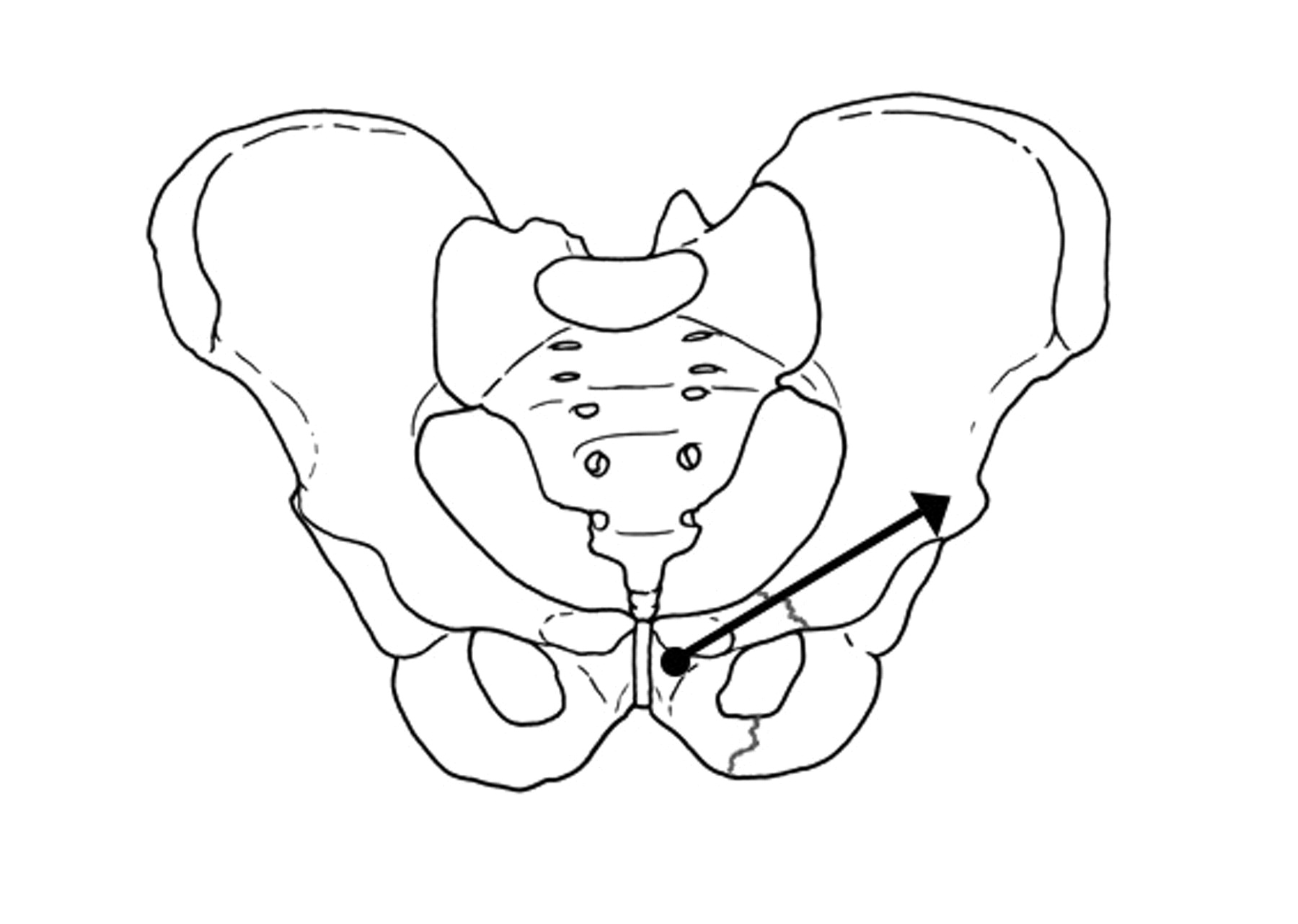 Percutaneous fixation of the pelvic ring | Bone & Joint