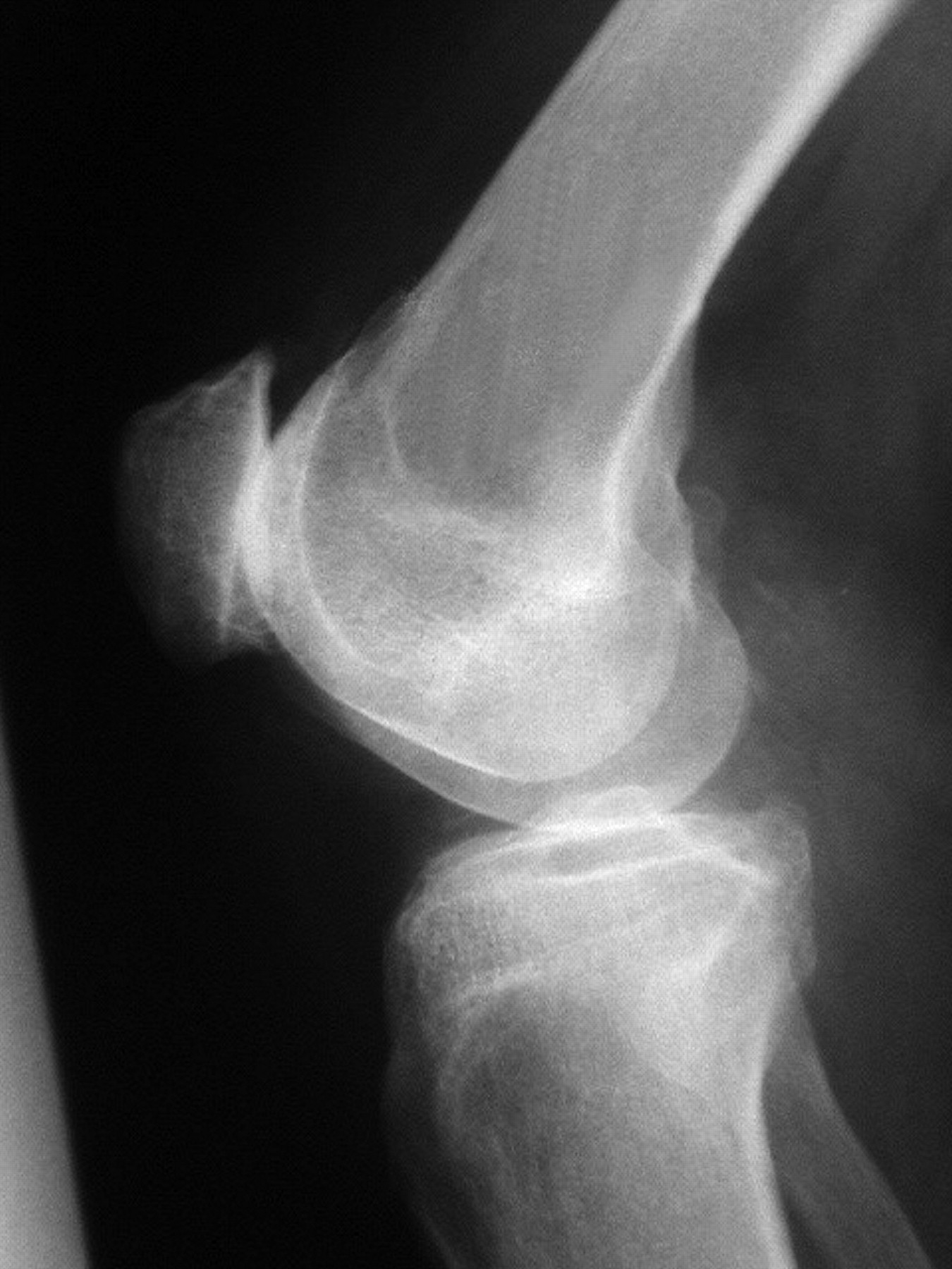 The Avon patellofemoral arthroplasty | Bone & Joint