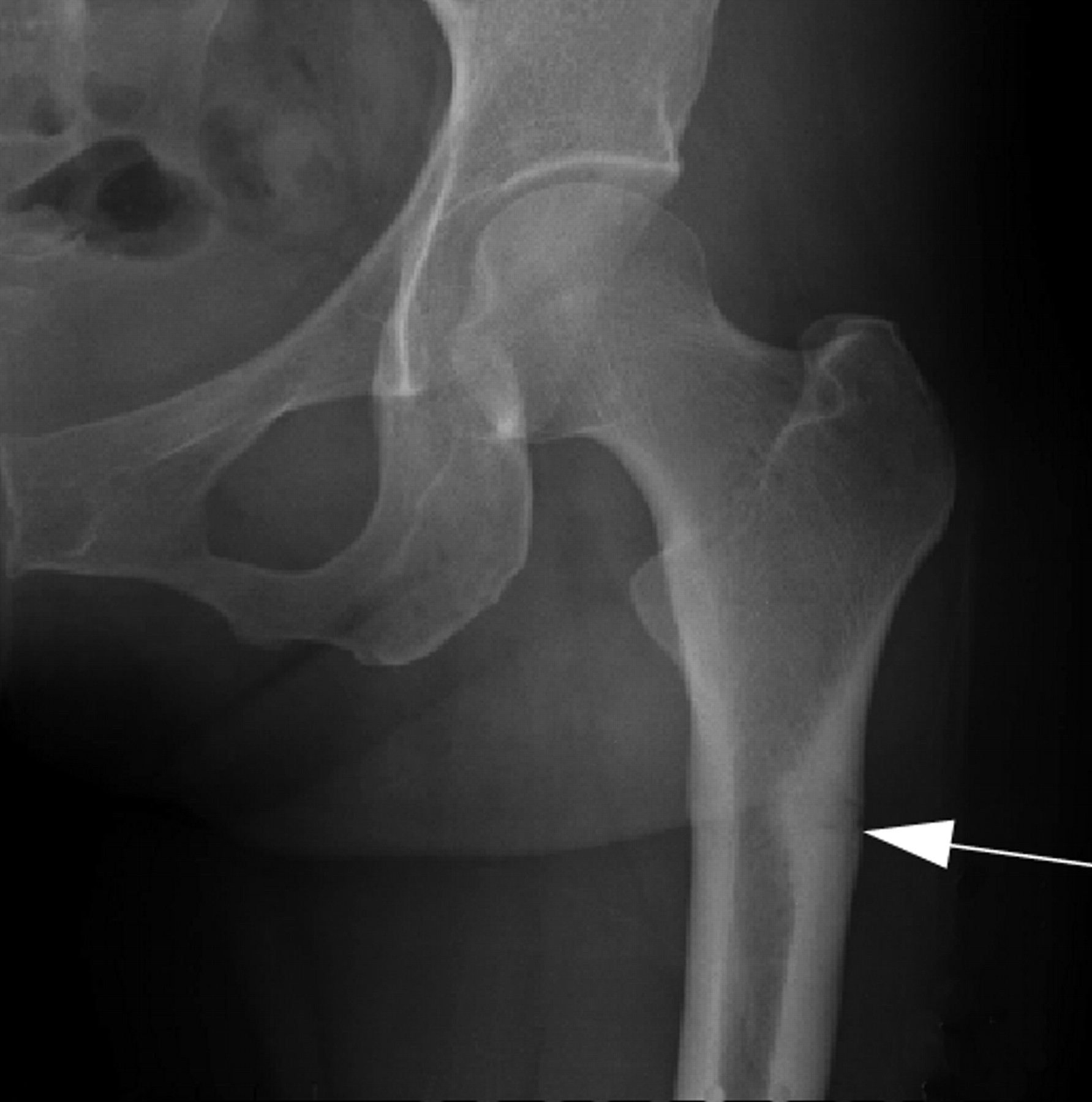 Subtrochanteric insufficiency fractures in patients on alendronate ...