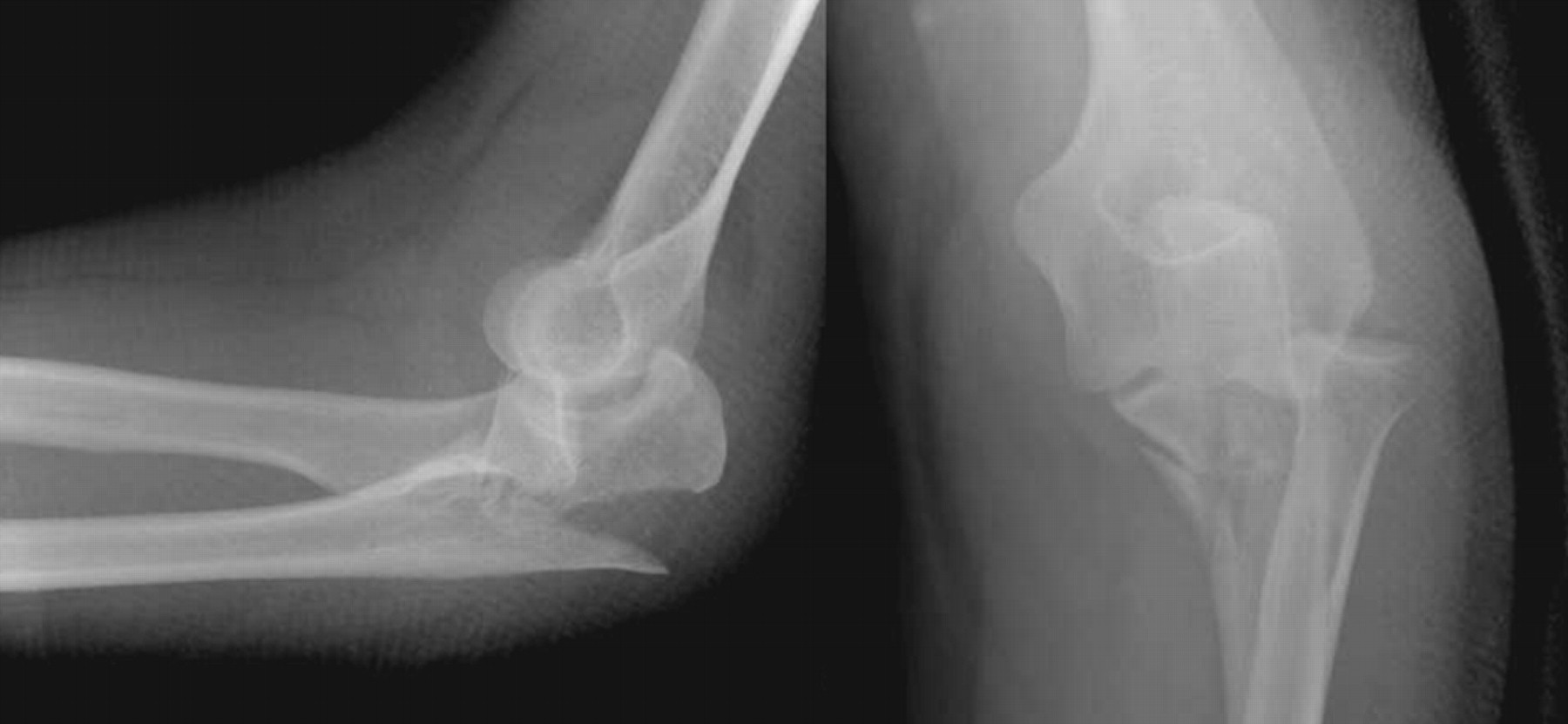 Monteggia Fractures In Adults | Bone & Joint