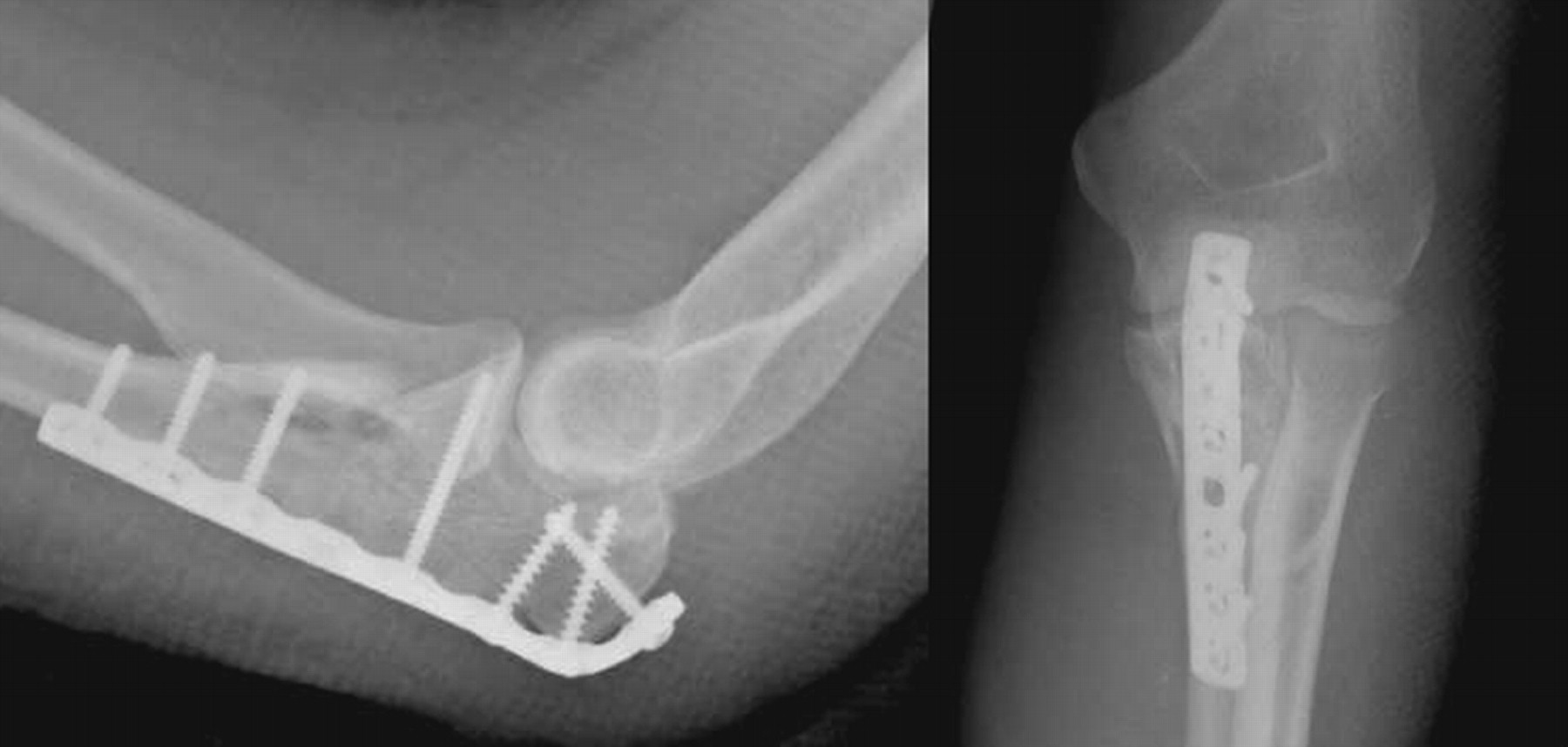 Monteggia Fractures In Adults Bone And Joint