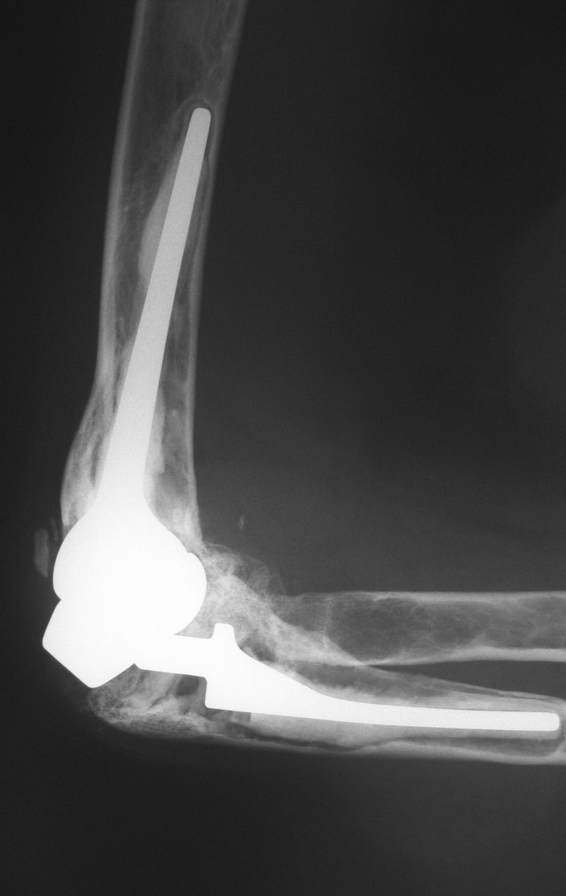 Gsb Iii Total Elbow Replacement In Rheumatoid Arthritis Bone And Joint