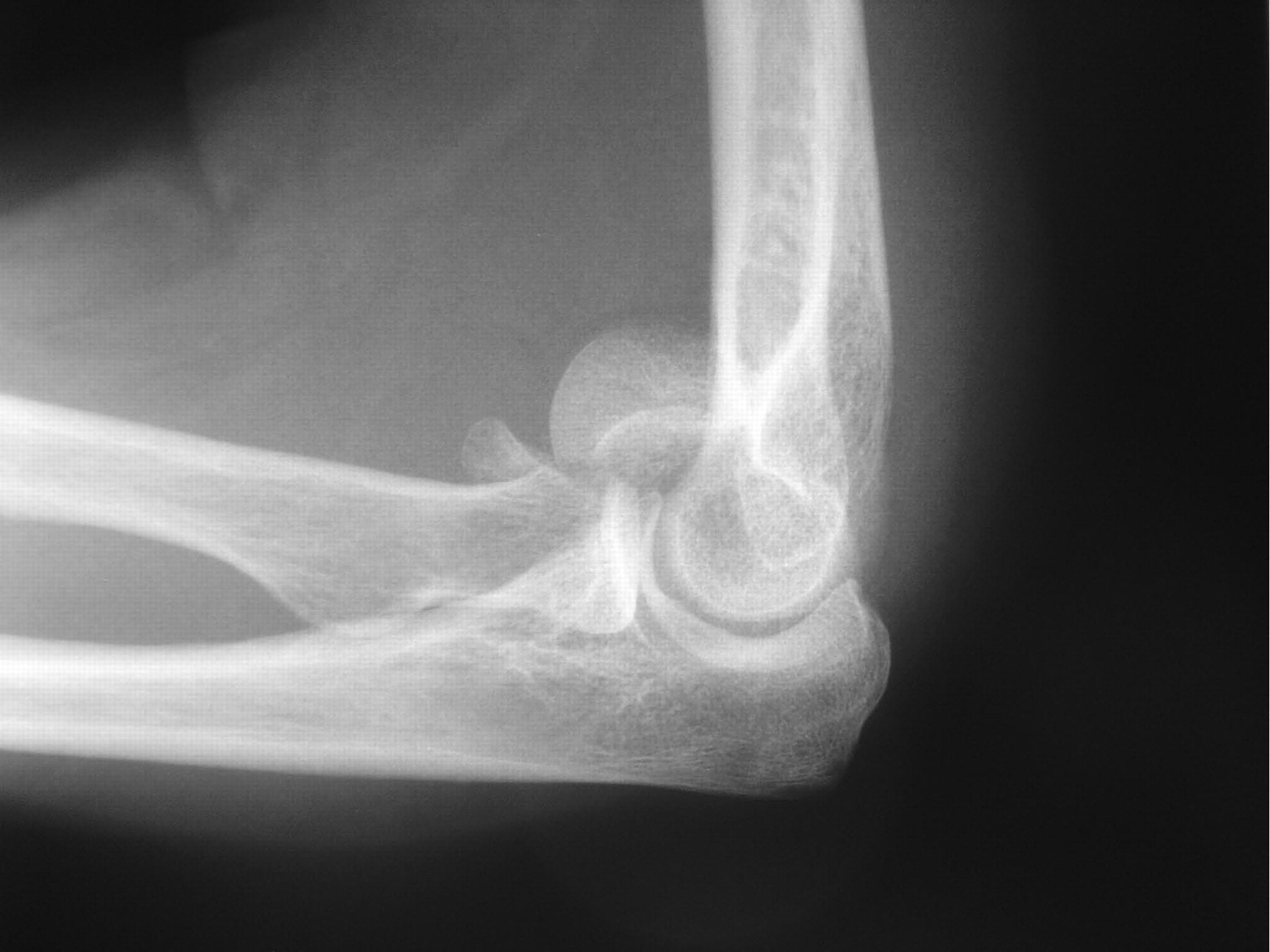 Fractures of the distal humeral articular surface | Bone & Joint