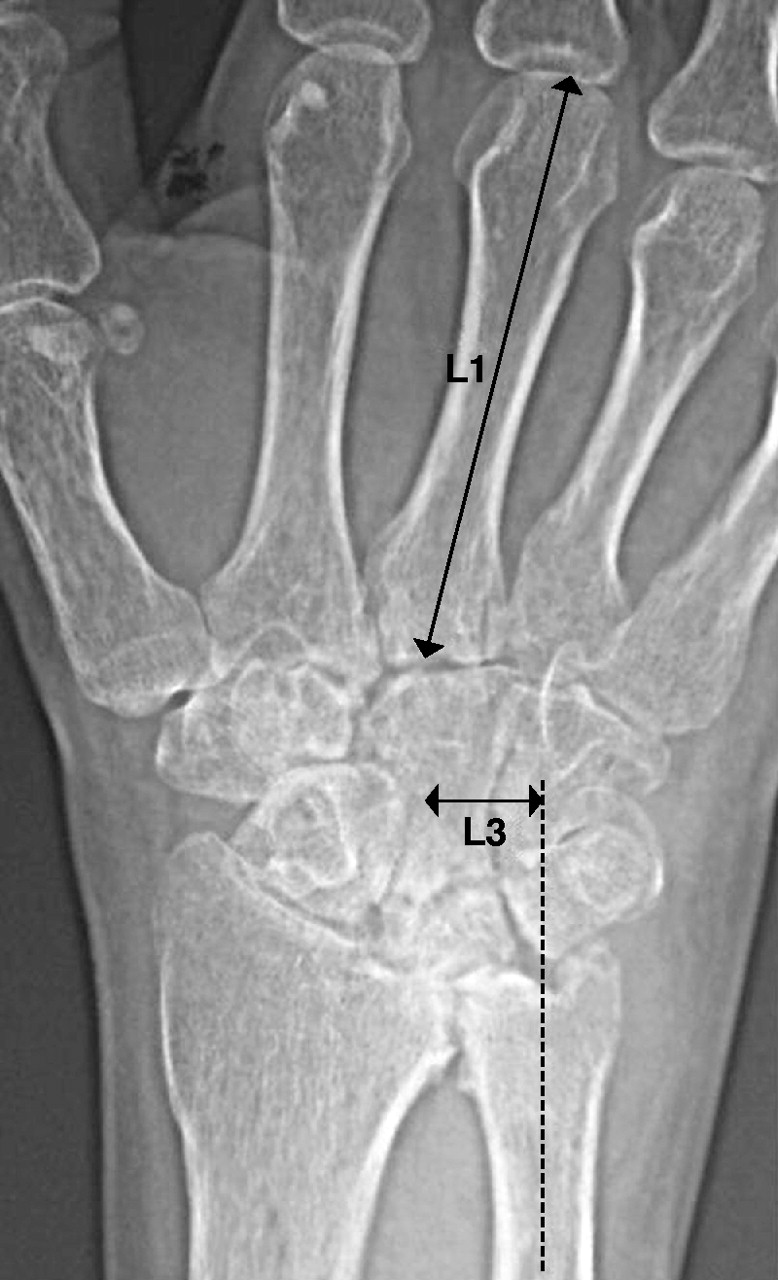 A three-dimensional quantitative analysis of carpal deformity in ...