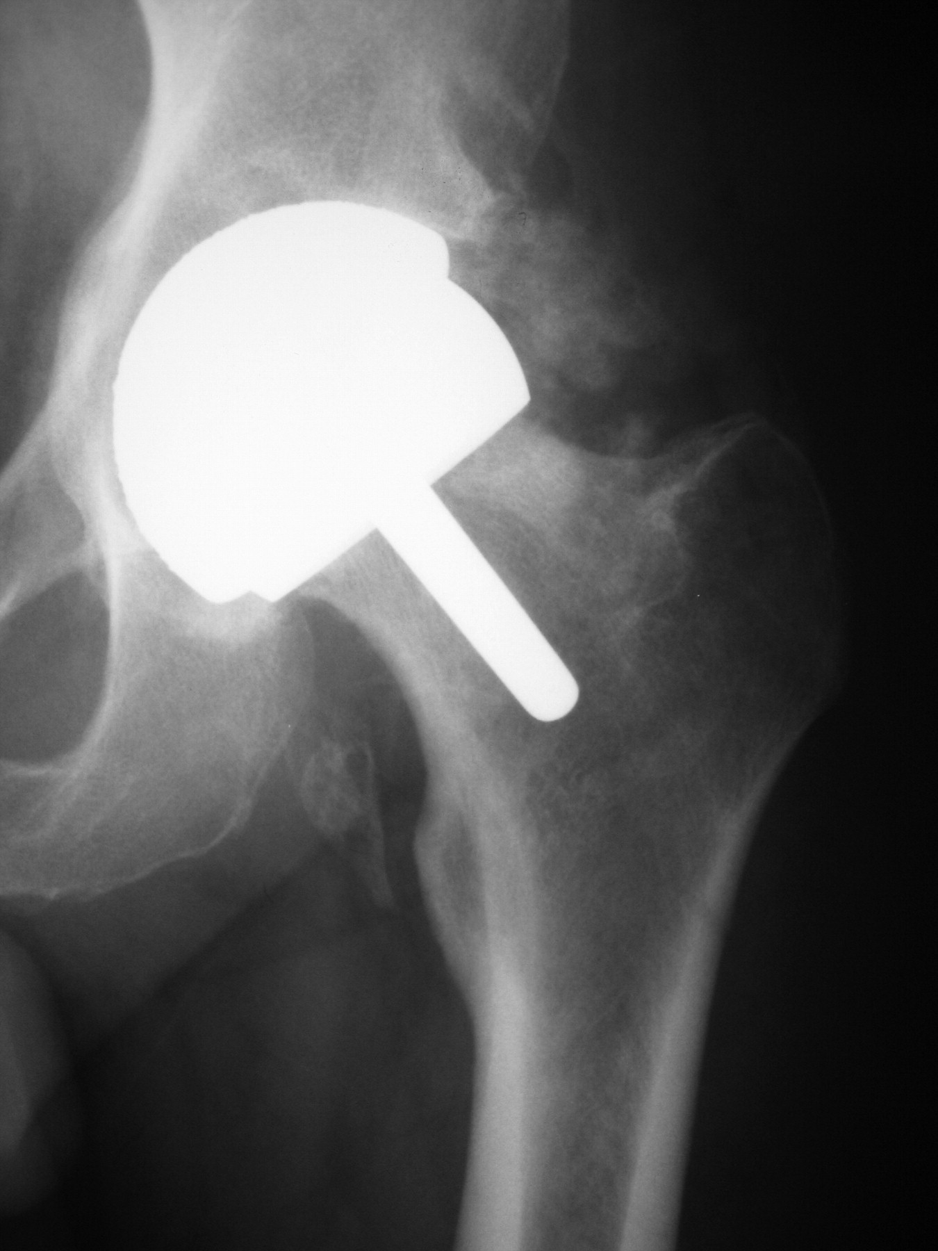 The Prophylaxis And Treatment Of Heterotopic Ossification Following ...