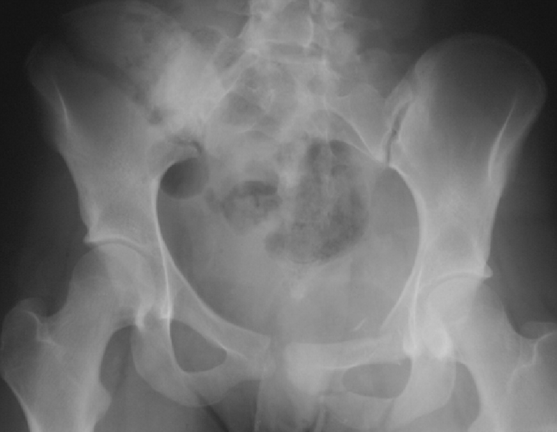 Crescent fracture-dislocation of the sacroiliac joint | Bone & Joint