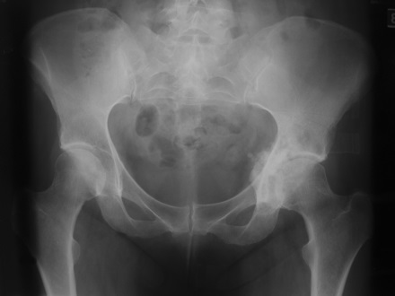 Radiation-induced sarcomas of bone | Bone & Joint