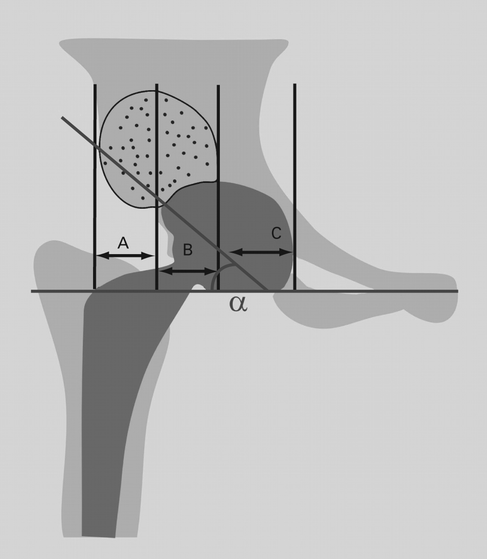 Position Of The Acetabular Component Determines The Fate Of Femoral ...