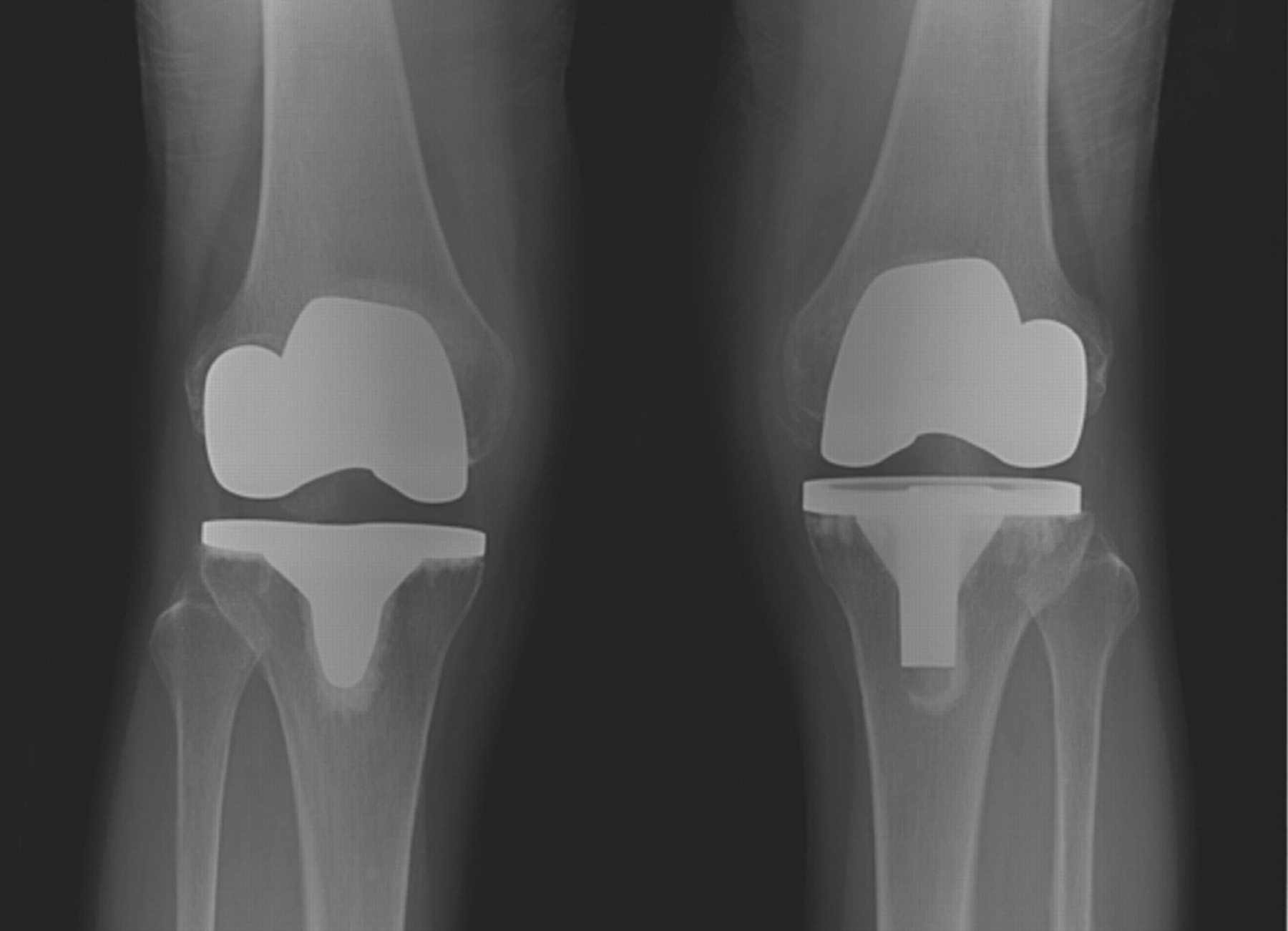 Simultaneous mobile- and fixed-bearing total knee replacement in the ...