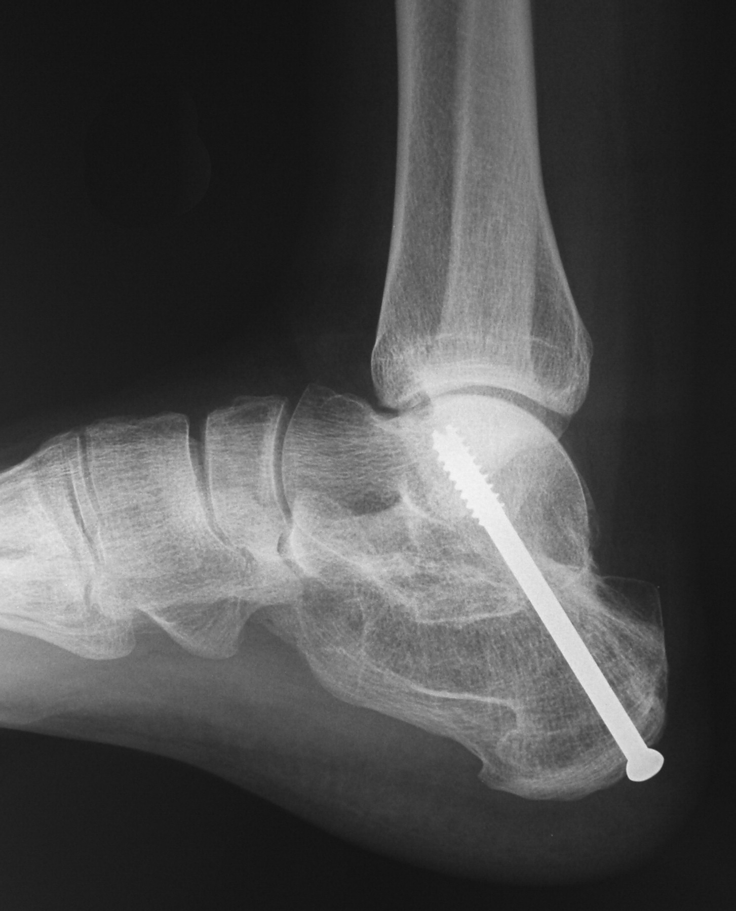 In Situ Arthrodesis With Lateral-wall Ostectomy For The Sequelae Of 