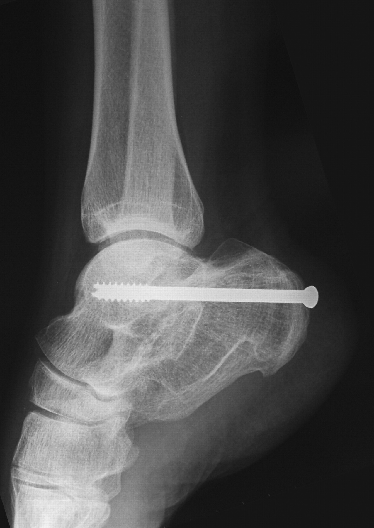 In situ arthrodesis with lateral-wall ostectomy for the sequelae of ...