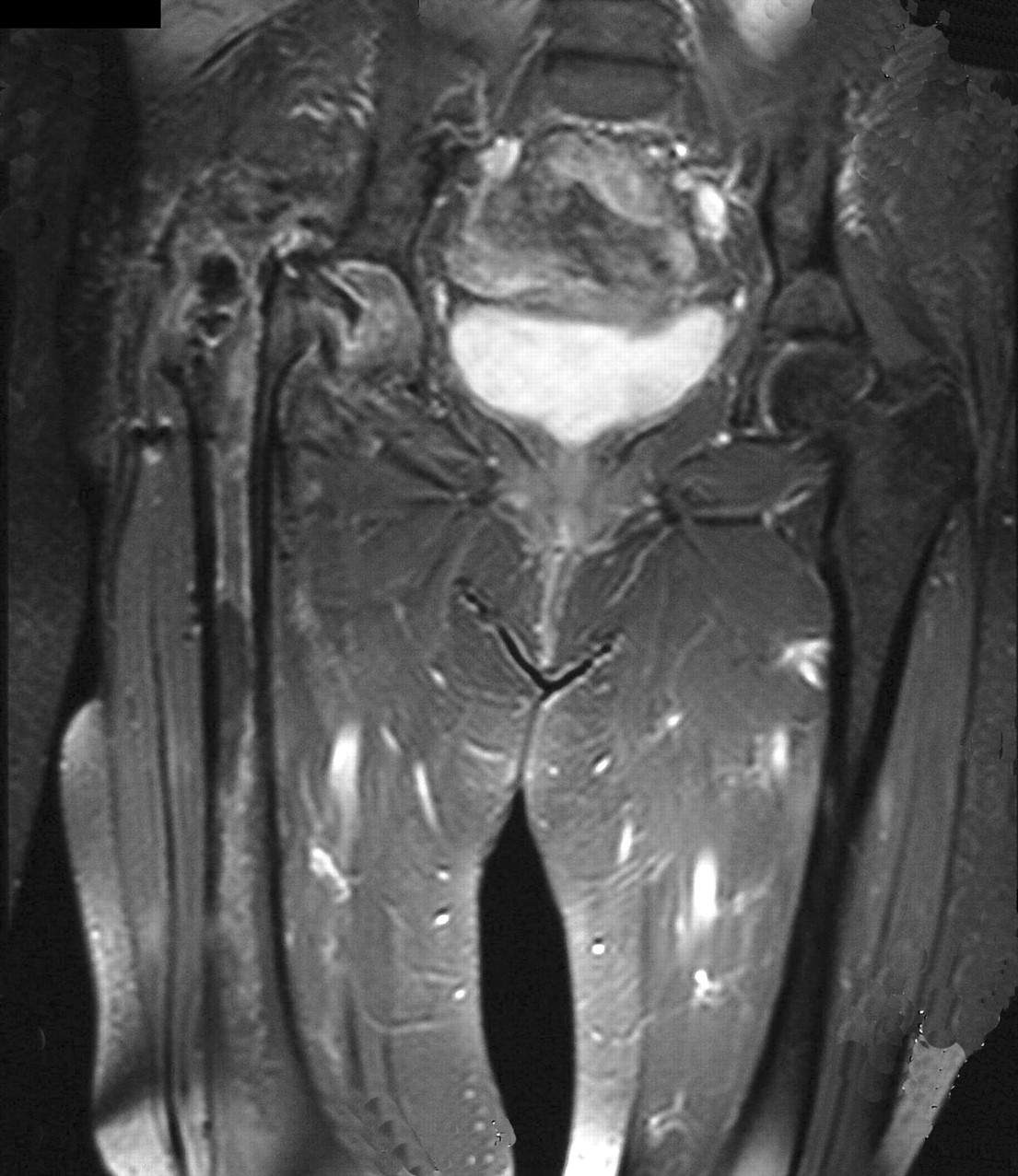 Acute Near-fatal Necrotising Fasciitis Complicating A Primary Total Hip 