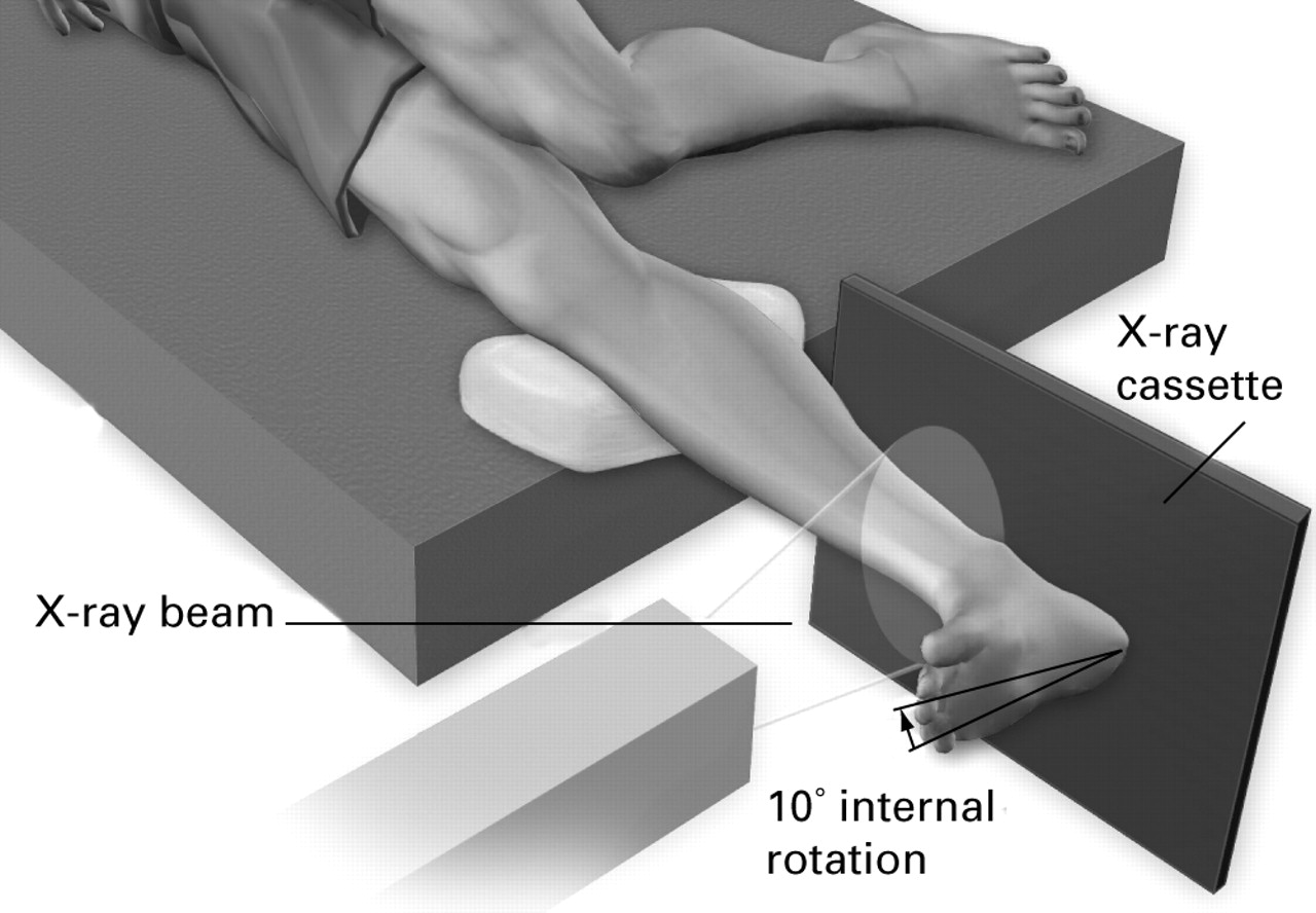 gravity stress view ankle radiopaedia