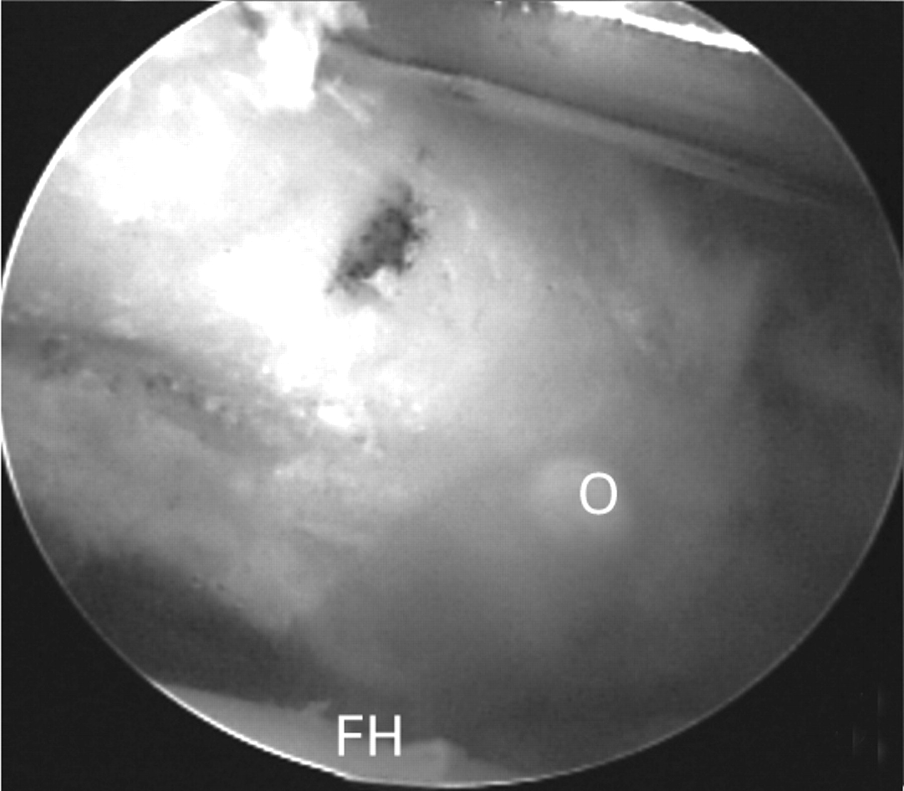 Arthroscopic treatment of femoroacetabular impingement secondary to ...