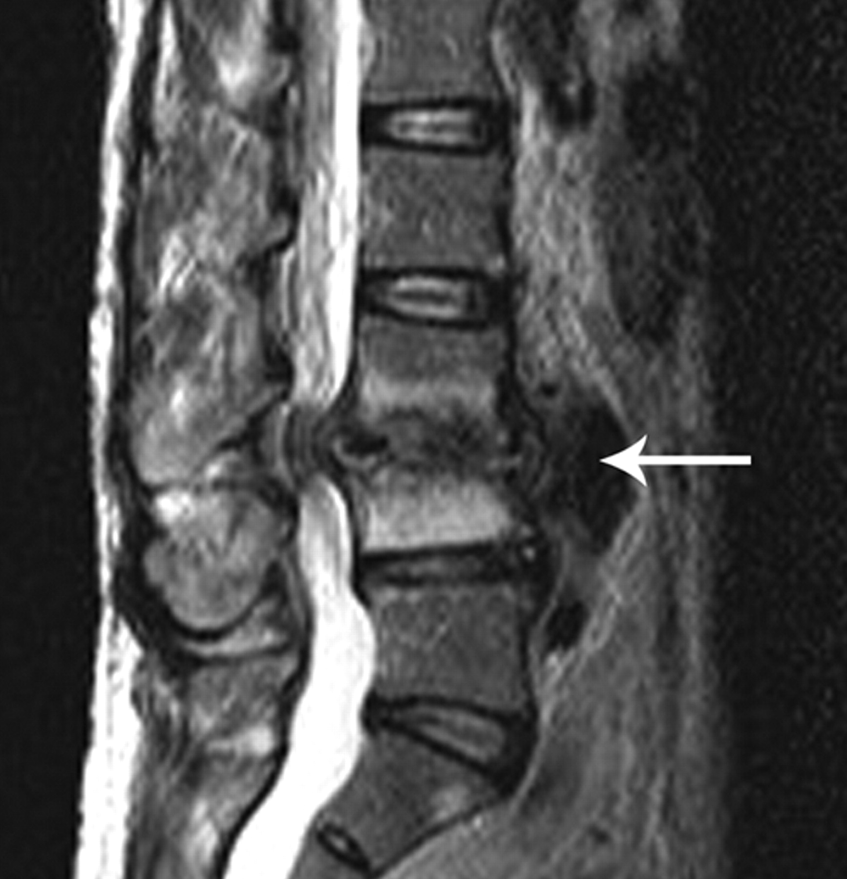 Treatment Of Haematogenous Pyogenic Vertebral Osteomyelitis By Single