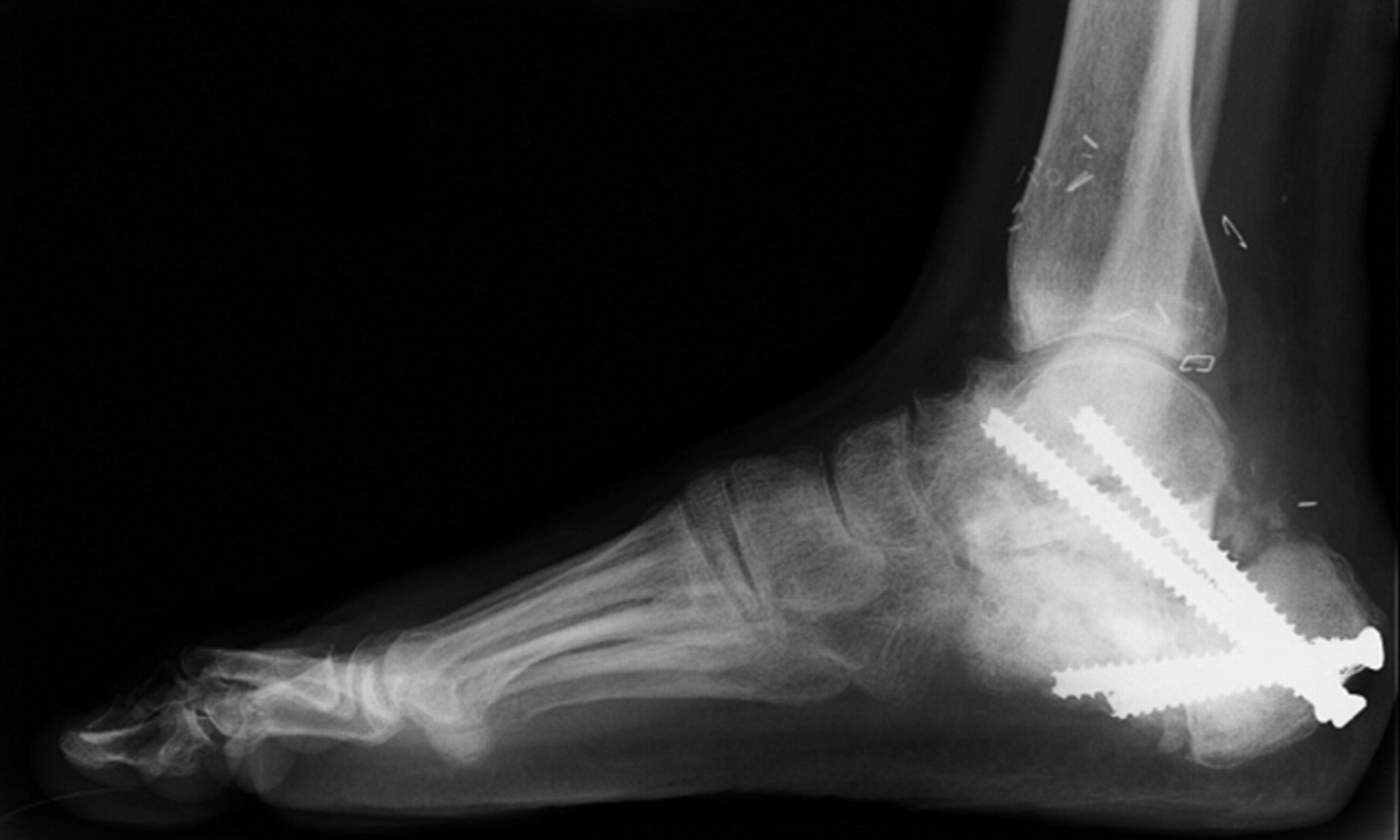 Symptomatic nonunion after fracture of the calcaneum | Bone & Joint