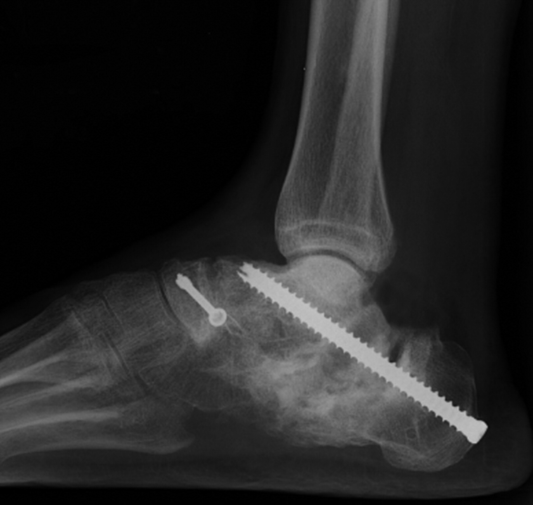 Symptomatic nonunion after fracture of the calcaneum | Bone & Joint