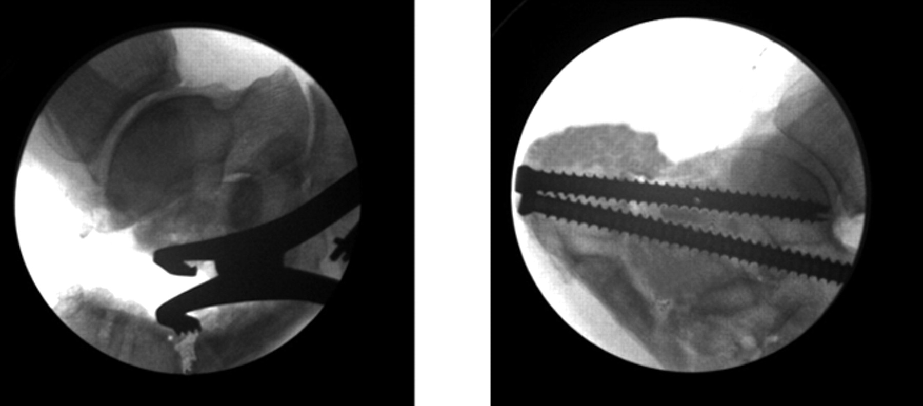 Symptomatic Nonunion After Fracture Of The Calcaneum | Bone & Joint