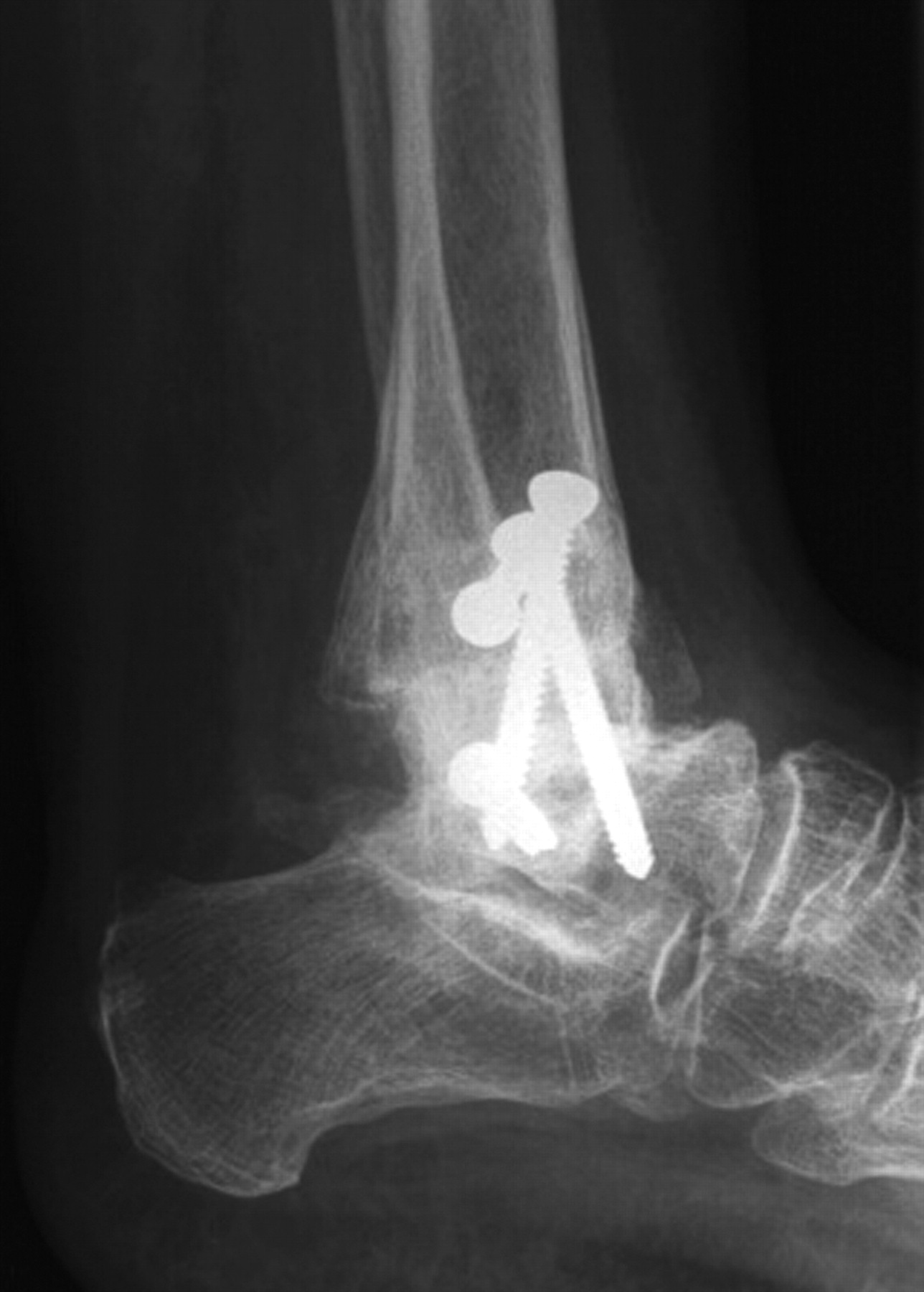 Arthrodesis after failed total ankle replacement | Bone & Joint