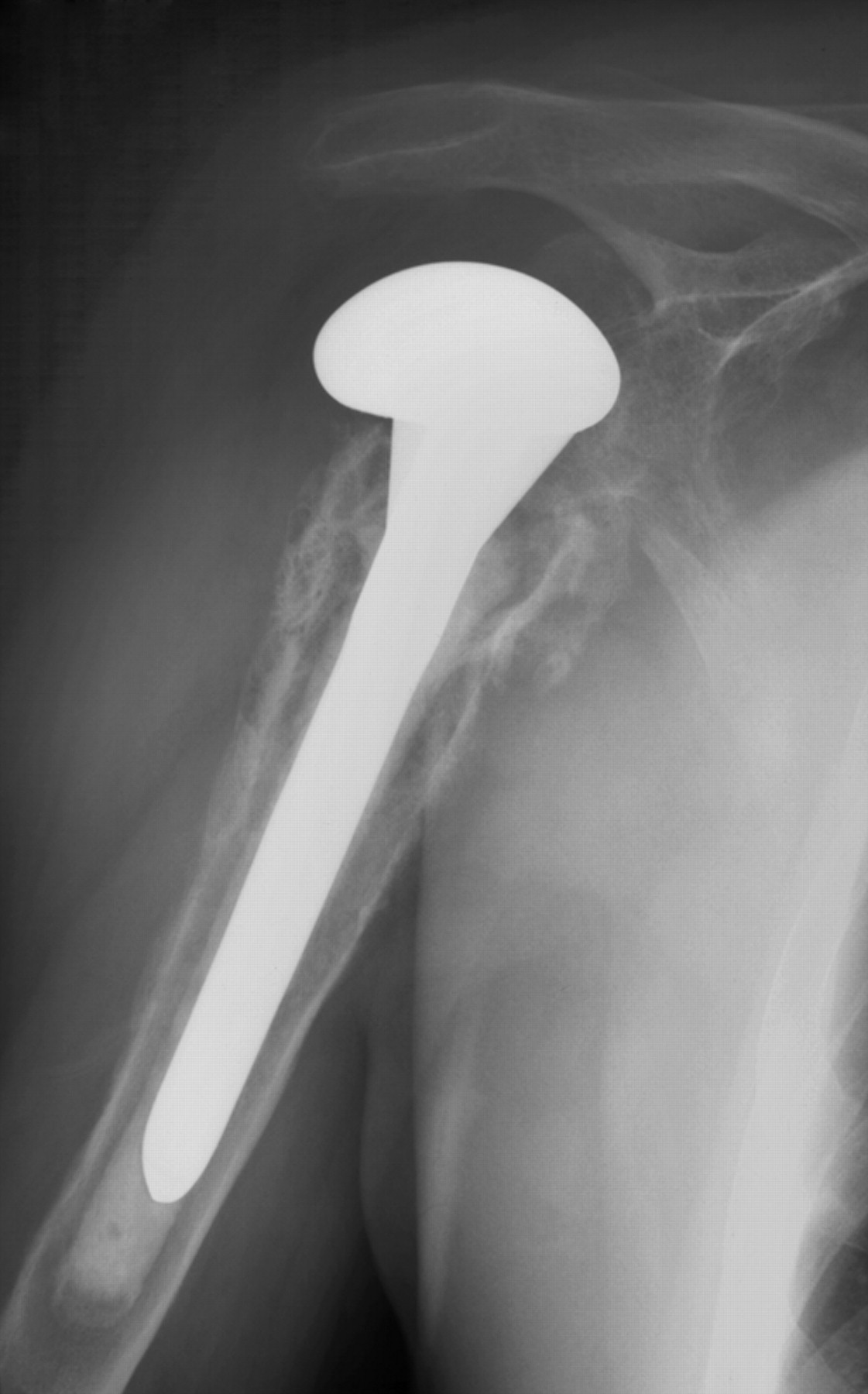 Pain Relief And Functional Results After Resection Arthroplasty Of The 