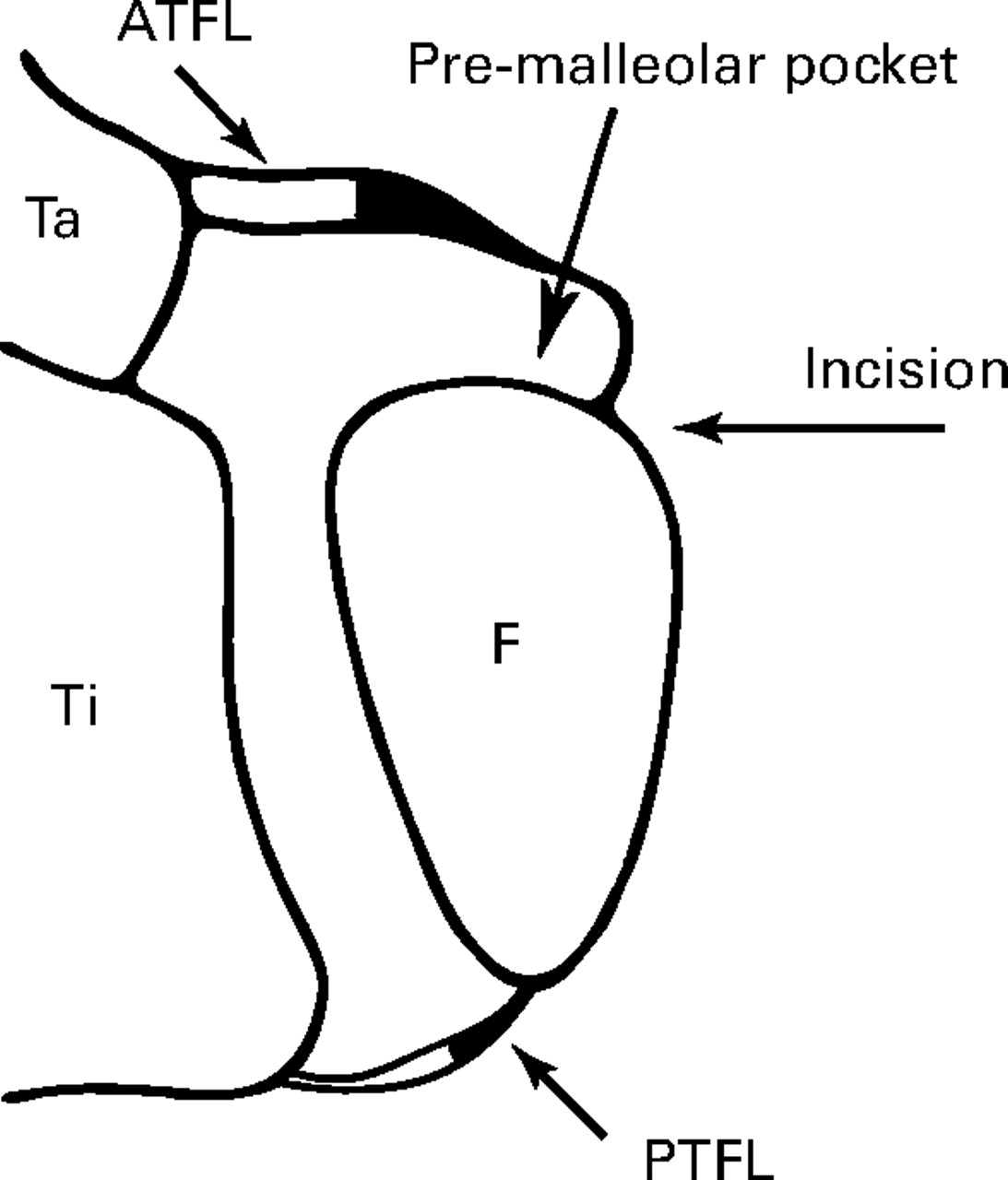 Clinical outcome after anatomical reconstruction of the lateral ankle ...