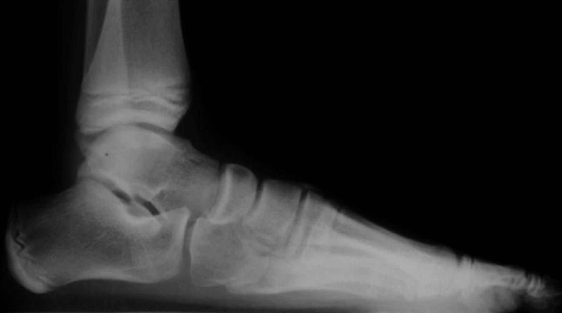 The Incidence And Treatment Of Rocker Bottom Deformity As A Complication Of The Conservative