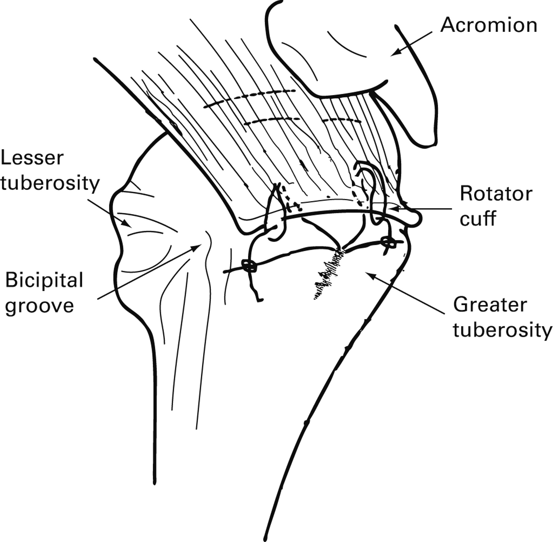 Mid-term clinical and sonographic outcome of arthroscopic repair of the ...