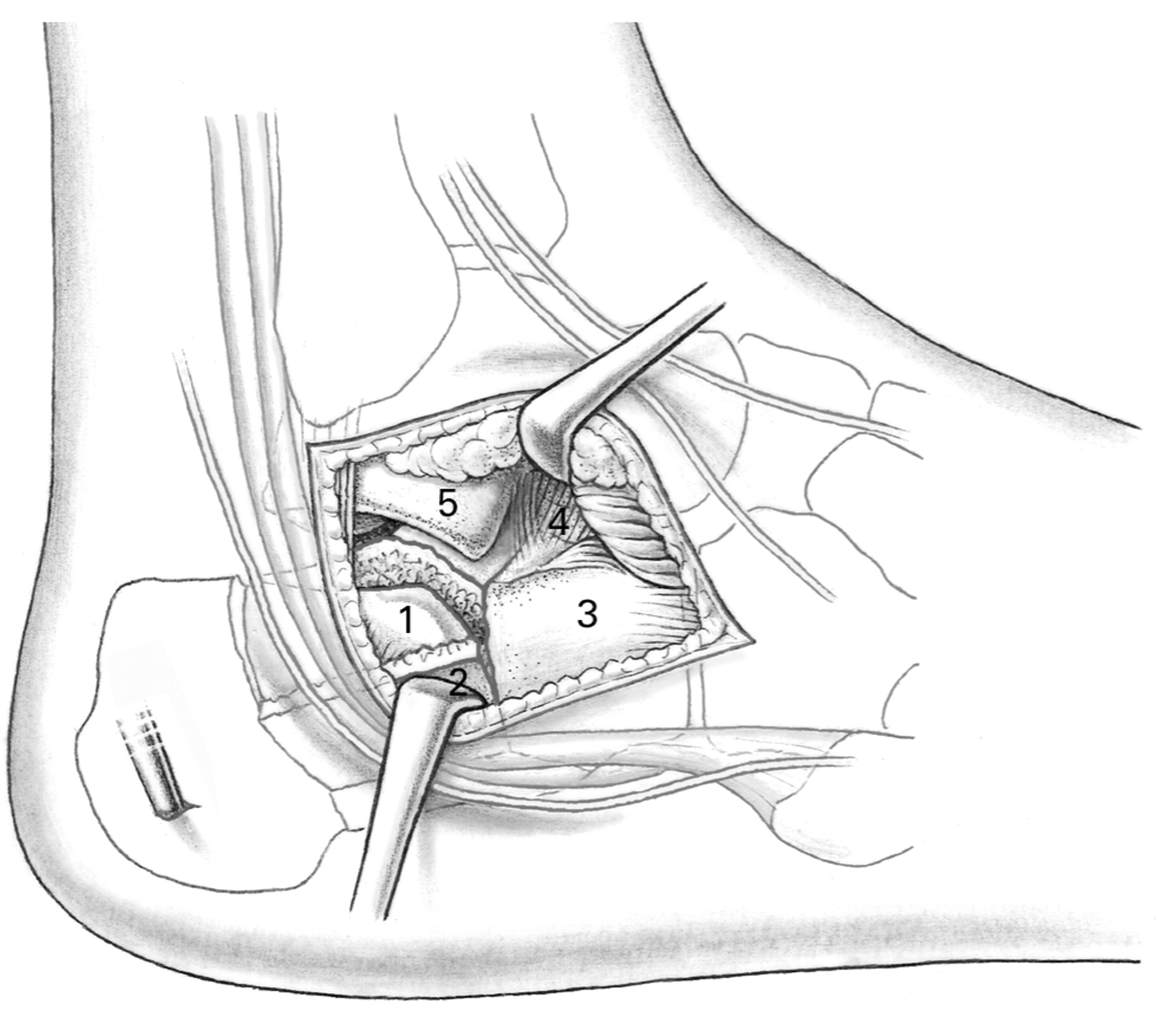 Limited open reduction and internal fixation of displaced intra ...