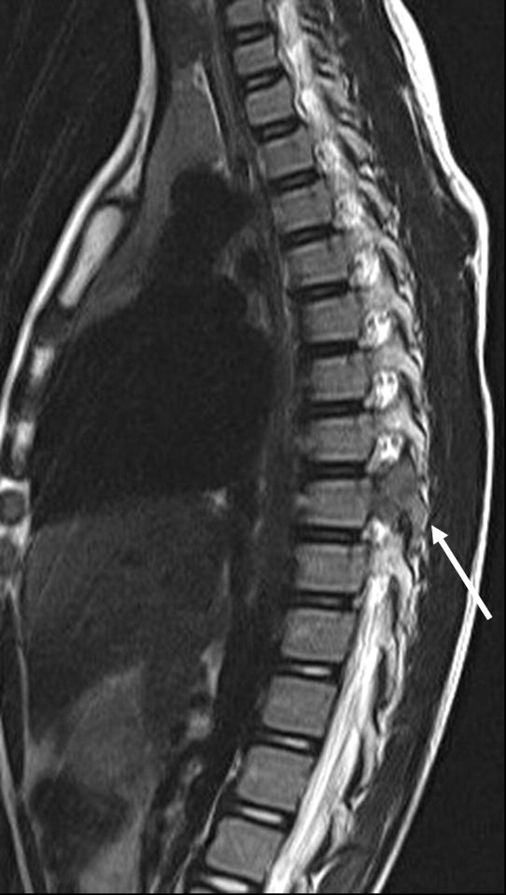 Giant-cell tumour of the synovium in a facet joint in the thoracic ...