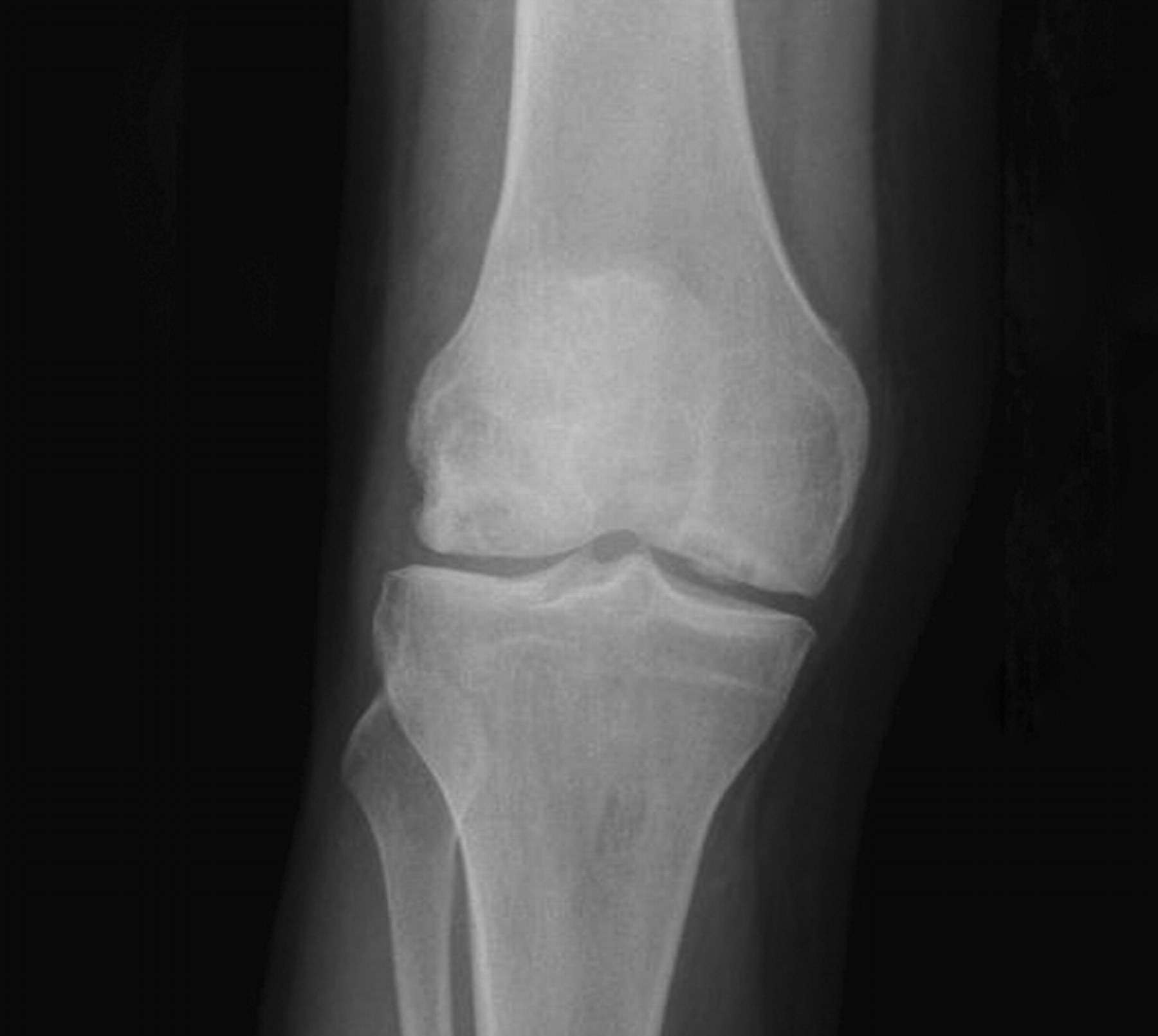 Bicondylar osteochondritis dissecans in the knee | Bone & Joint