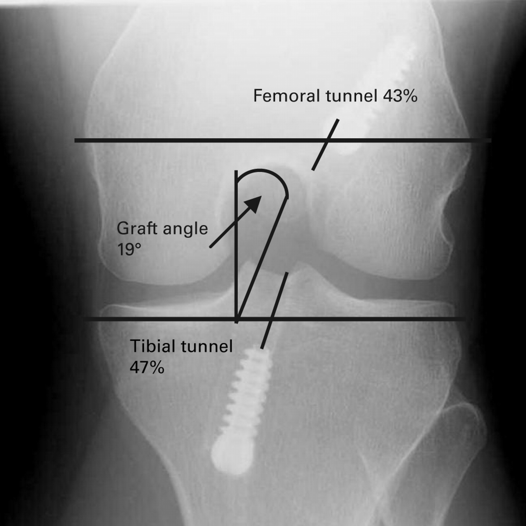 Radiological Landmarks For Placement Of The Tunnels In Single-bundle ...