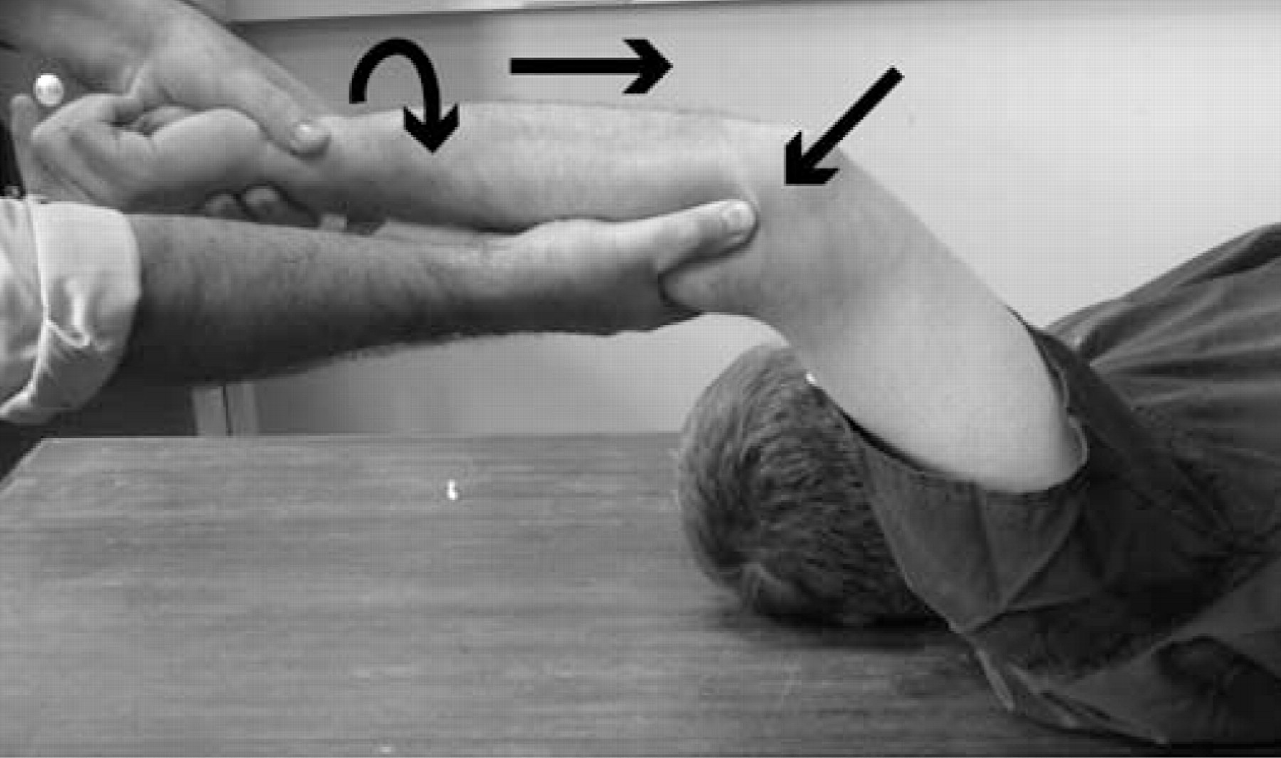 Posterolateral rotatory instability of the elbow | Bone & Joint