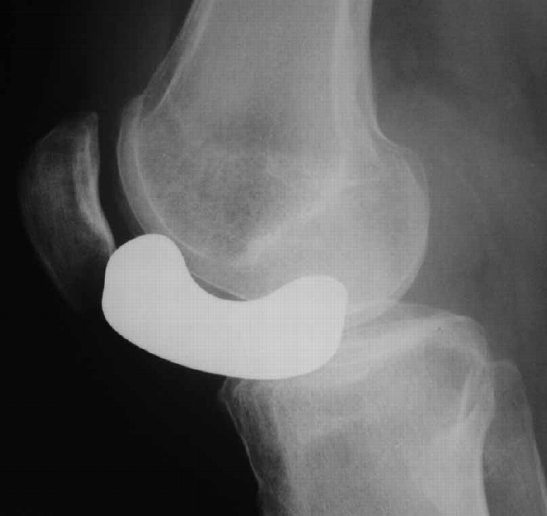 The Unispacer knee implant Bone & Joint