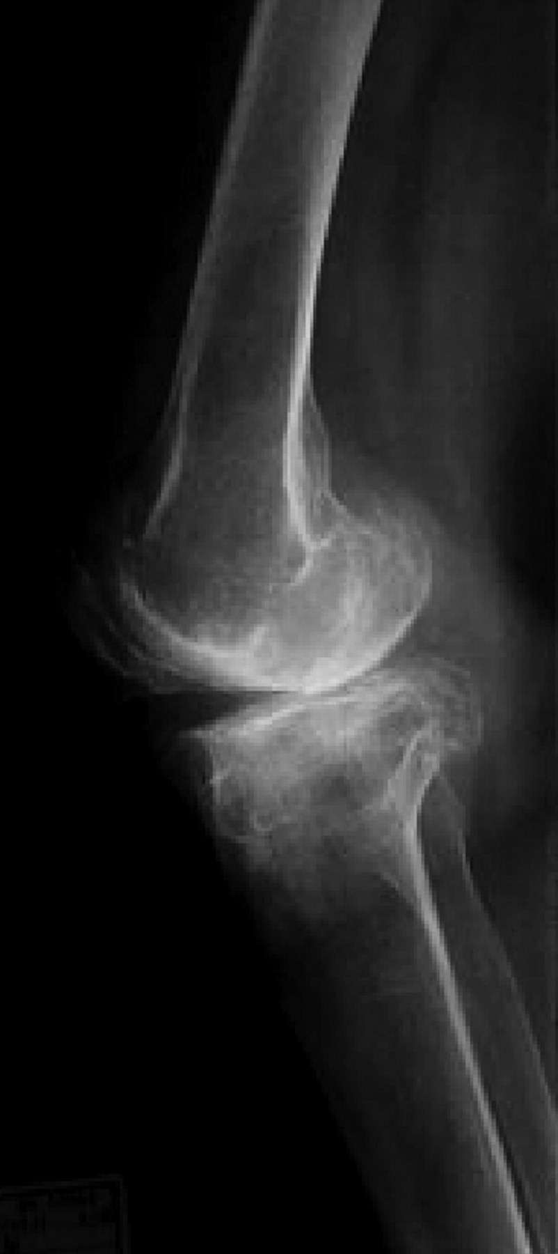 The Long-term Outcome Of High Tibial Osteotomy | Bone & Joint