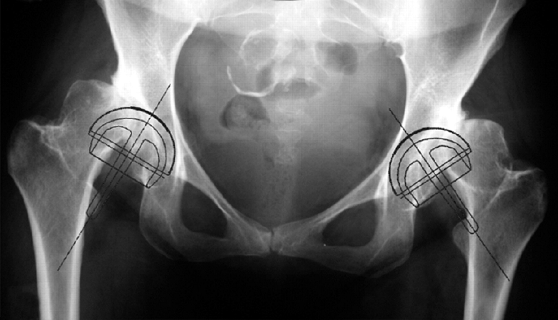 Results Of The Birmingham Hip Resurfacing Dysplasia Component In Severe ...